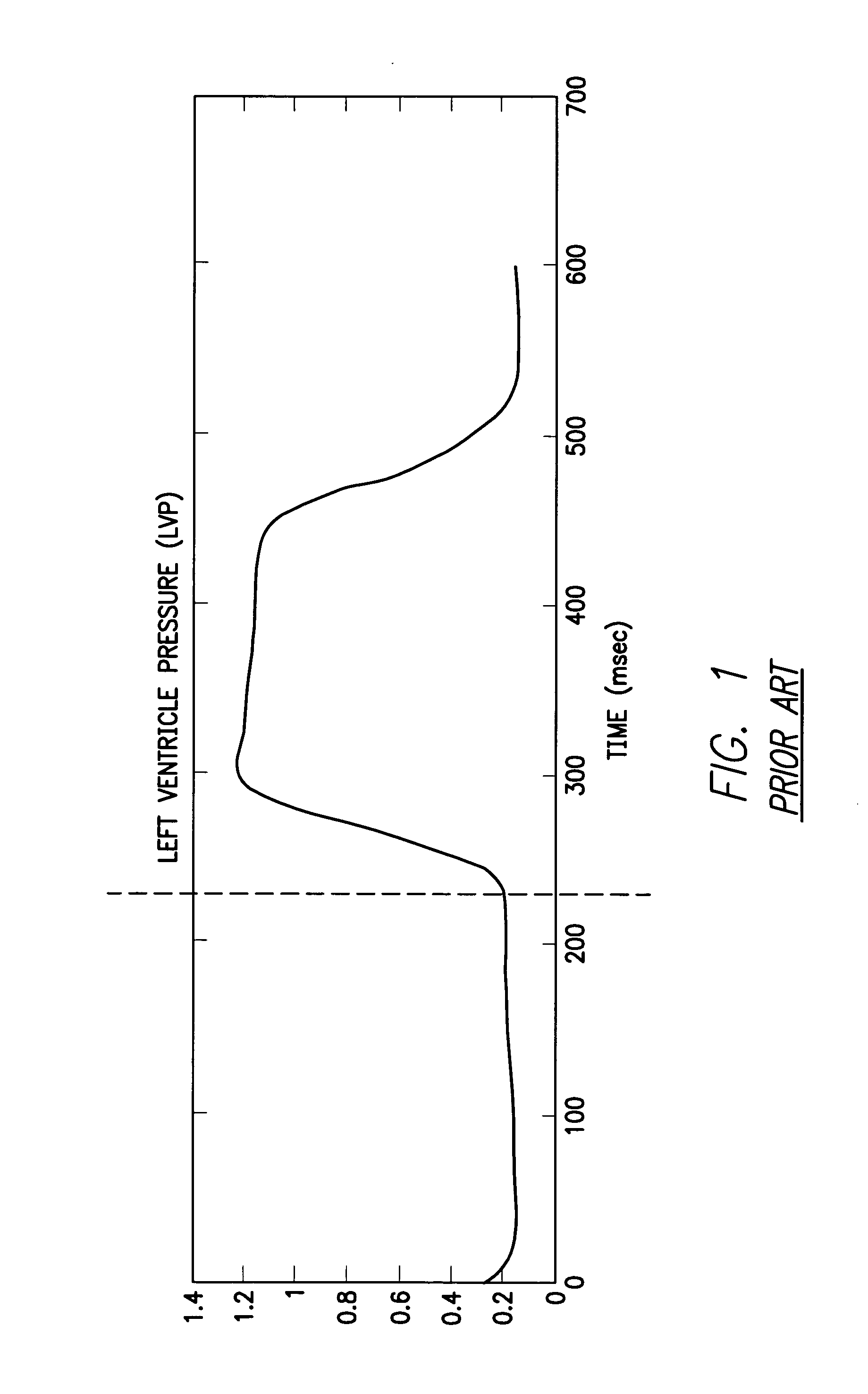 System and method for detecting heart failure and pulmonary edema based on ventricular end-diastolic pressure using an implantable medical device