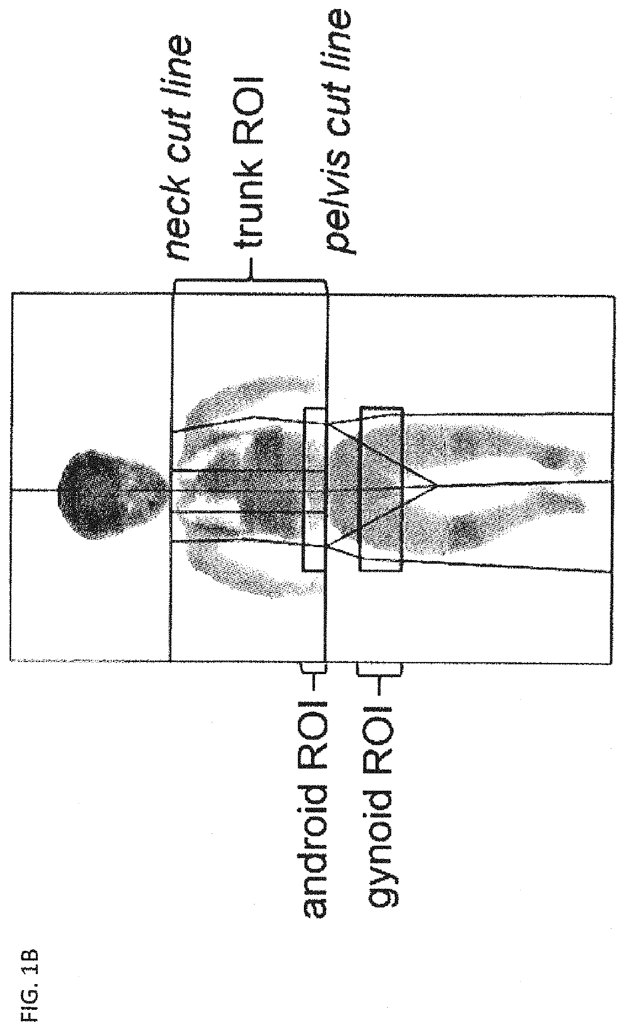 Treatment of abnormal visceral fat deposition using soluble fibroblast growth factor receptor 3 (sfgfr3) polypeptides