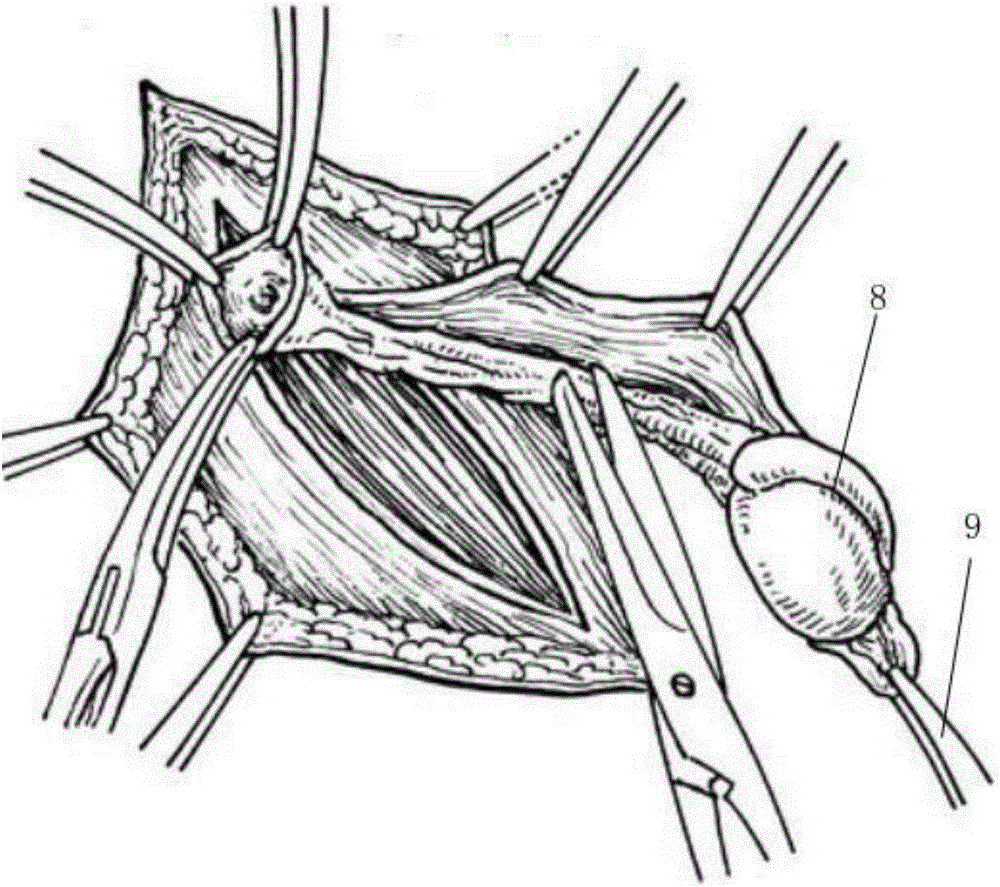 Testicular descent grasping forceps for cryptorchidism surgery