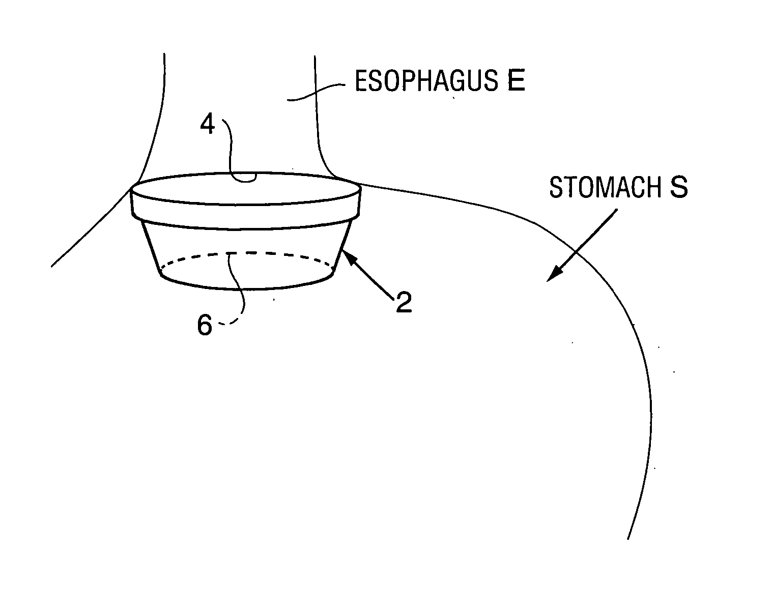 Method and apparatus for modifying the exit orifice of a satiation pouch
