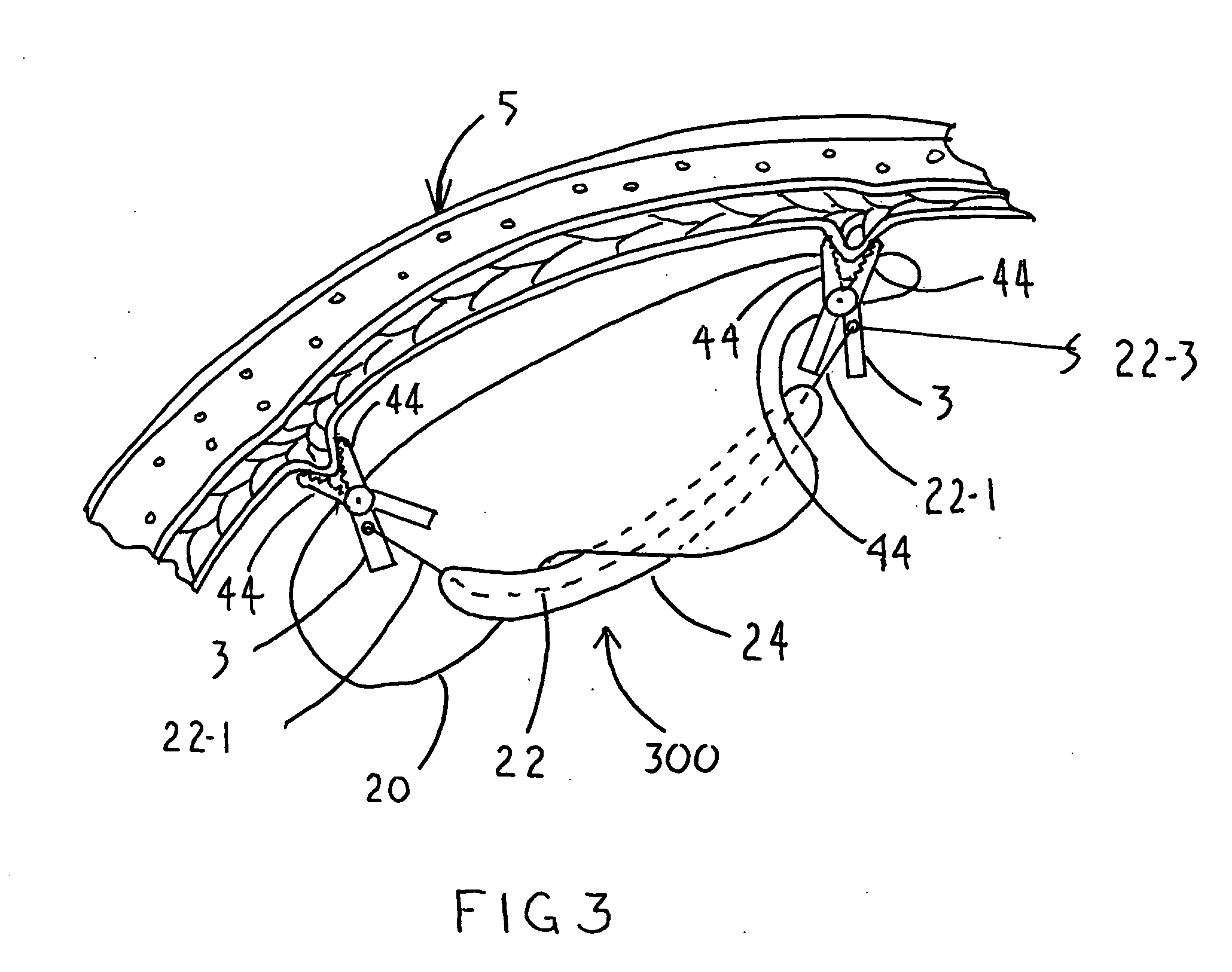 Linear tension internal organ supports and method for using the same