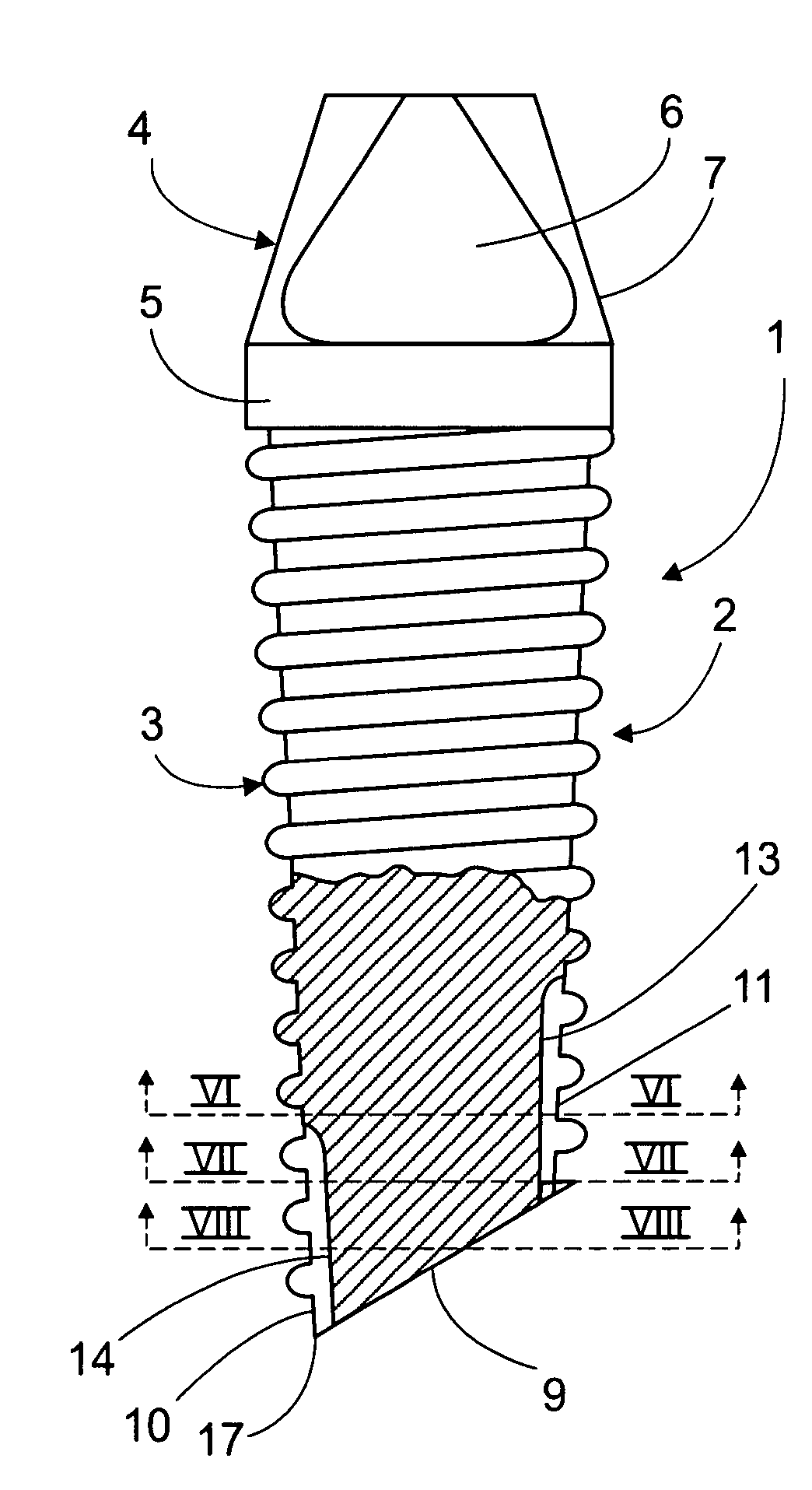 Threaded implant with improved distal end