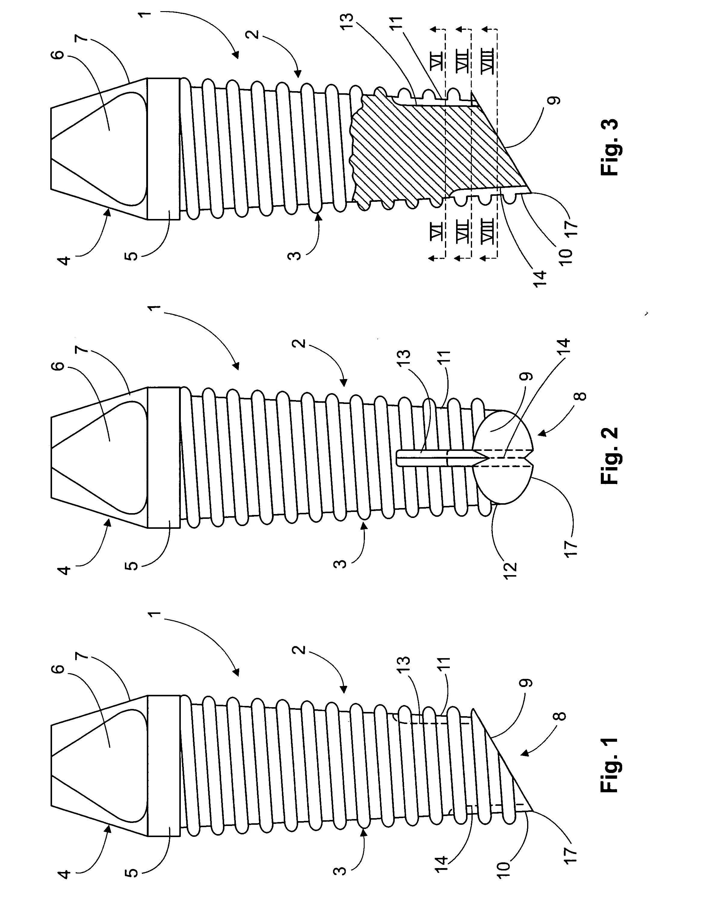 Threaded implant with improved distal end