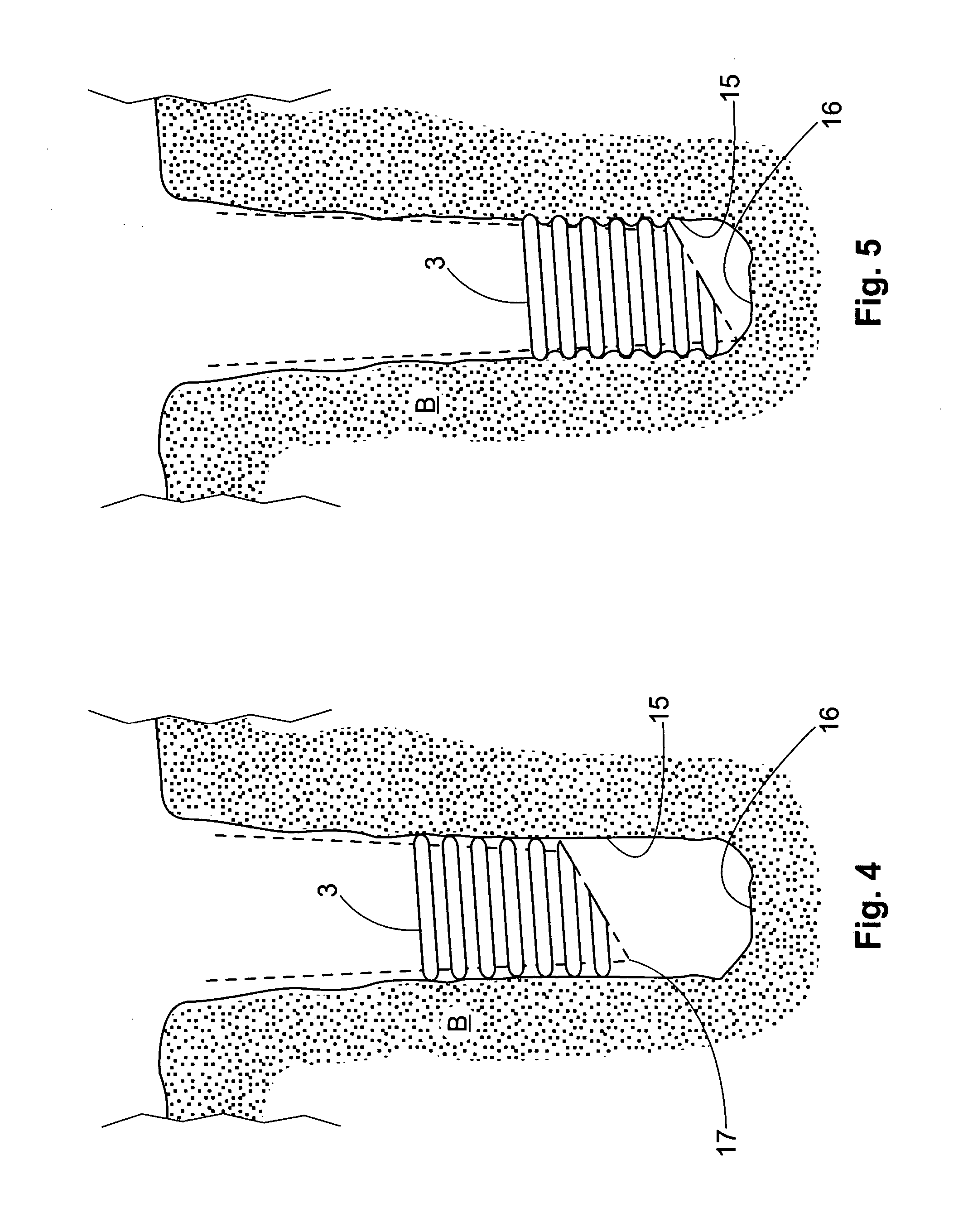 Threaded implant with improved distal end