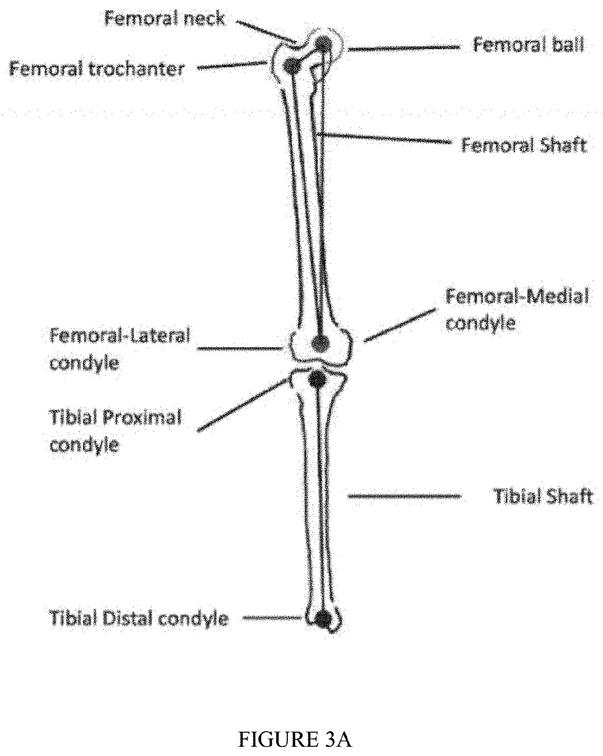 A method for obtaining 3-d deformity correction for bones