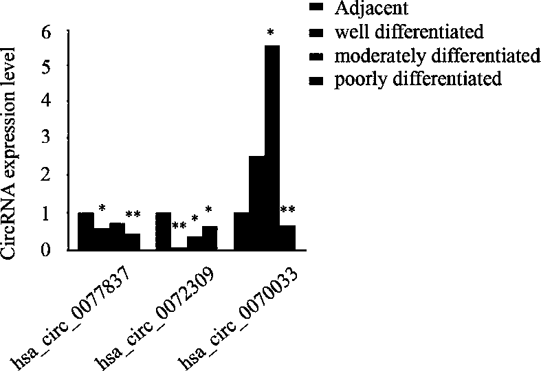 CircRNA markers for diagnosing poorly differentiated adenocarcinoma of stomach and application thereof