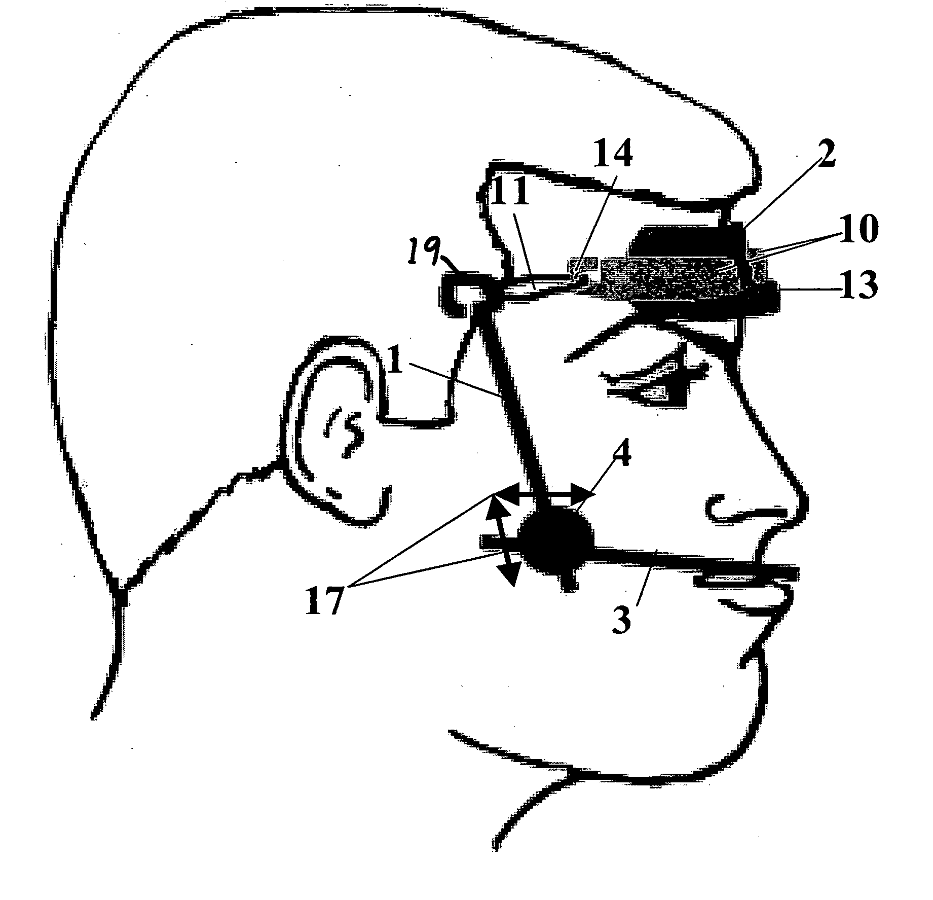 Protraction headgear