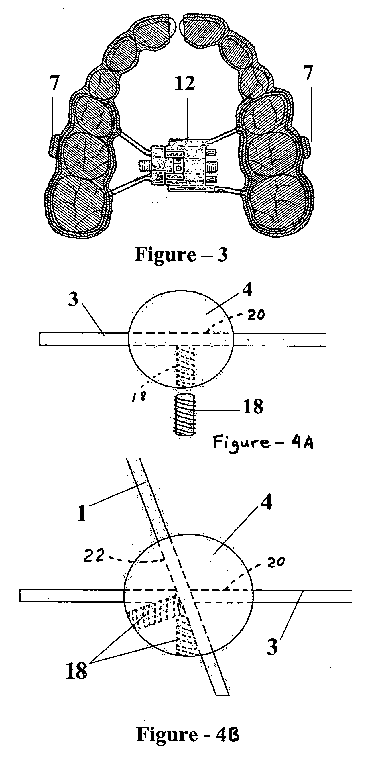 Protraction headgear