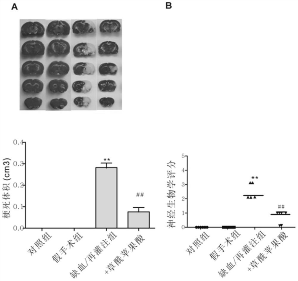 Application of oxalomalic acid in preparation of medicine for treating nerve cell injury