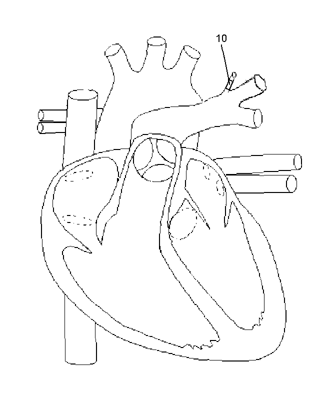 Delivery method and system for monitoring cardiovascular pressures