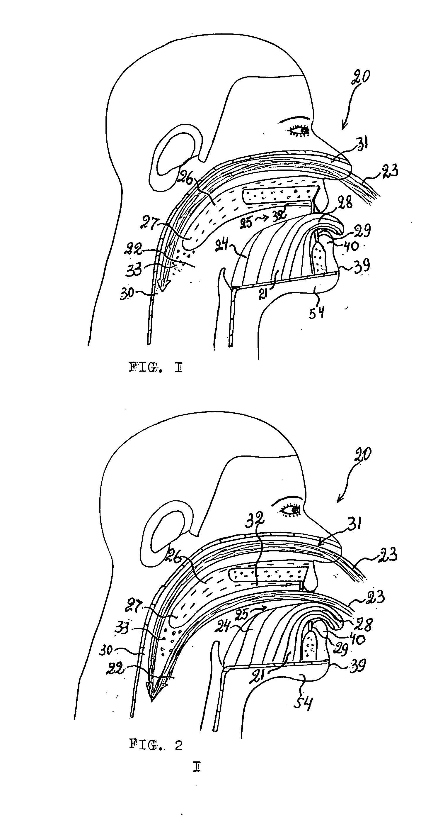 Device for the treatment of snoring and obstructive sleep apnea