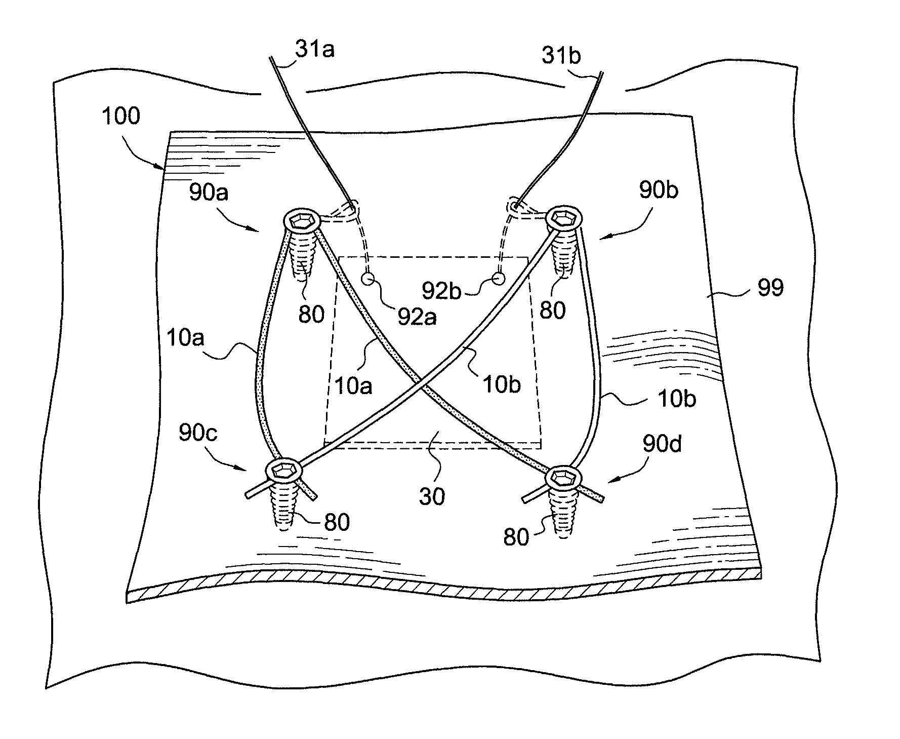 Method of forming knotless double row construct with graft or patch fixed under repair site