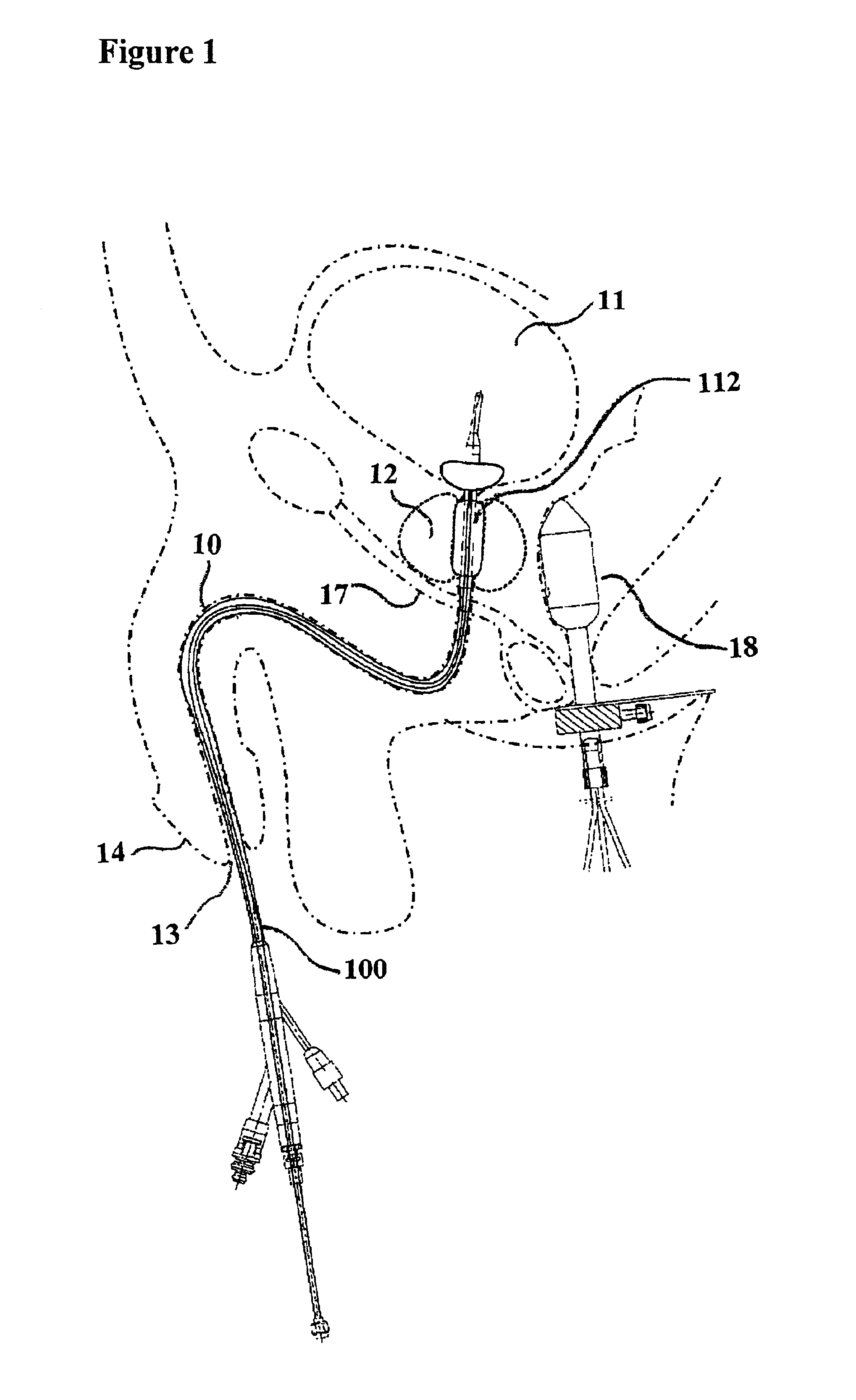 Device and method for treatment of tissue adjacent a bodily conduit by thermocompression