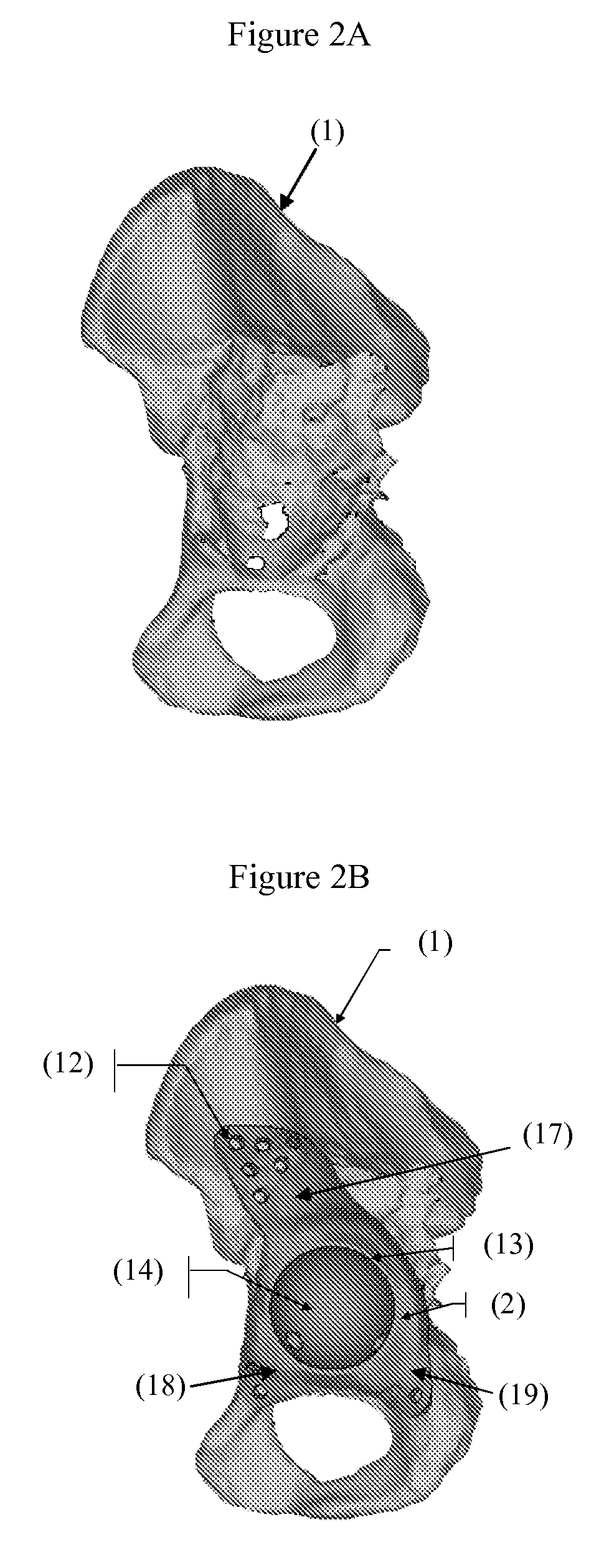 Customized surgical guides, methods for manufacturing and uses thereof
