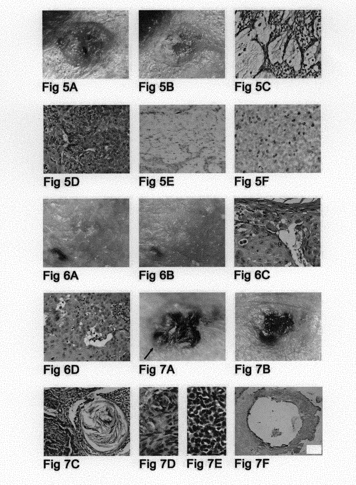 Drug treatment of tumors wherein hedgehog/smoothened signaling is utilized for inhibition of apoptosis of tumor cells