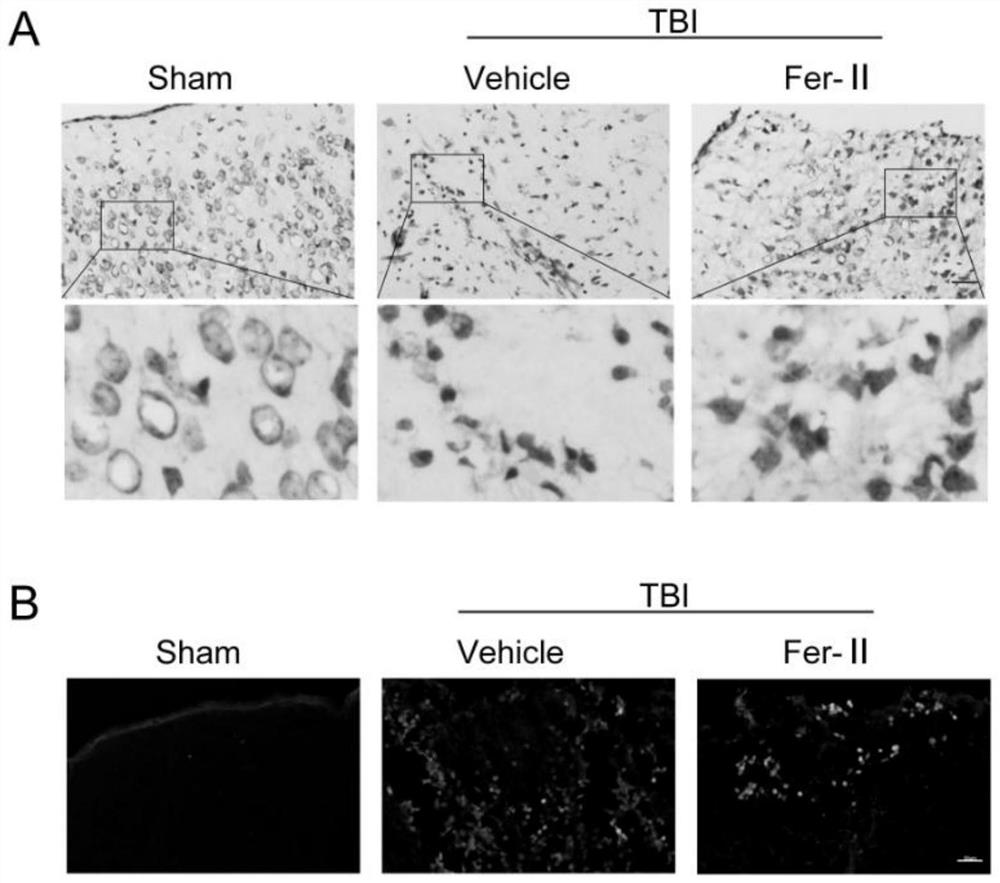 Application of transferrin receptor inhibitor Ferristatin-II in preparation of medicine for treating cerebral trauma