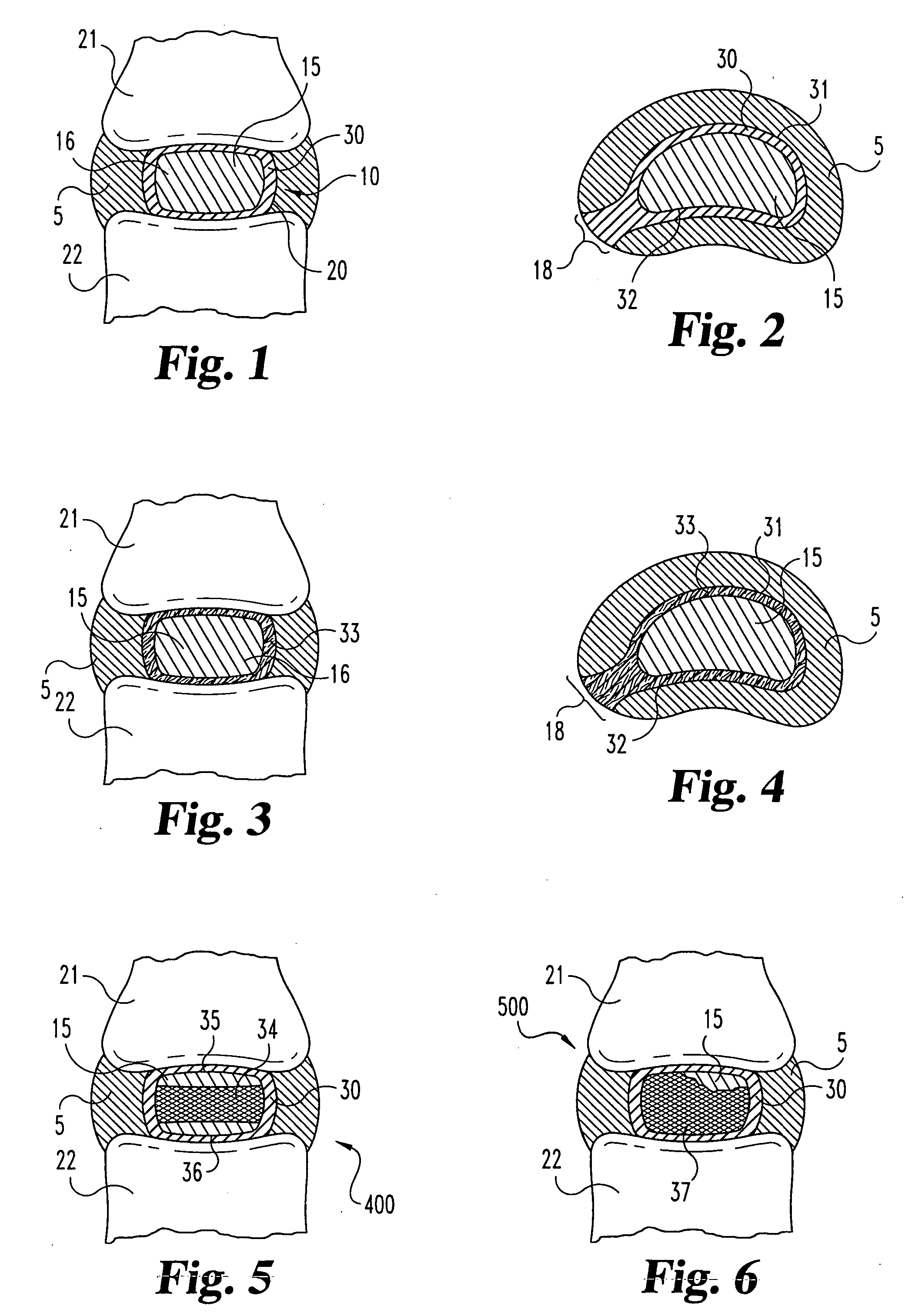 Methods for forming and retaining intervertebral disc implants