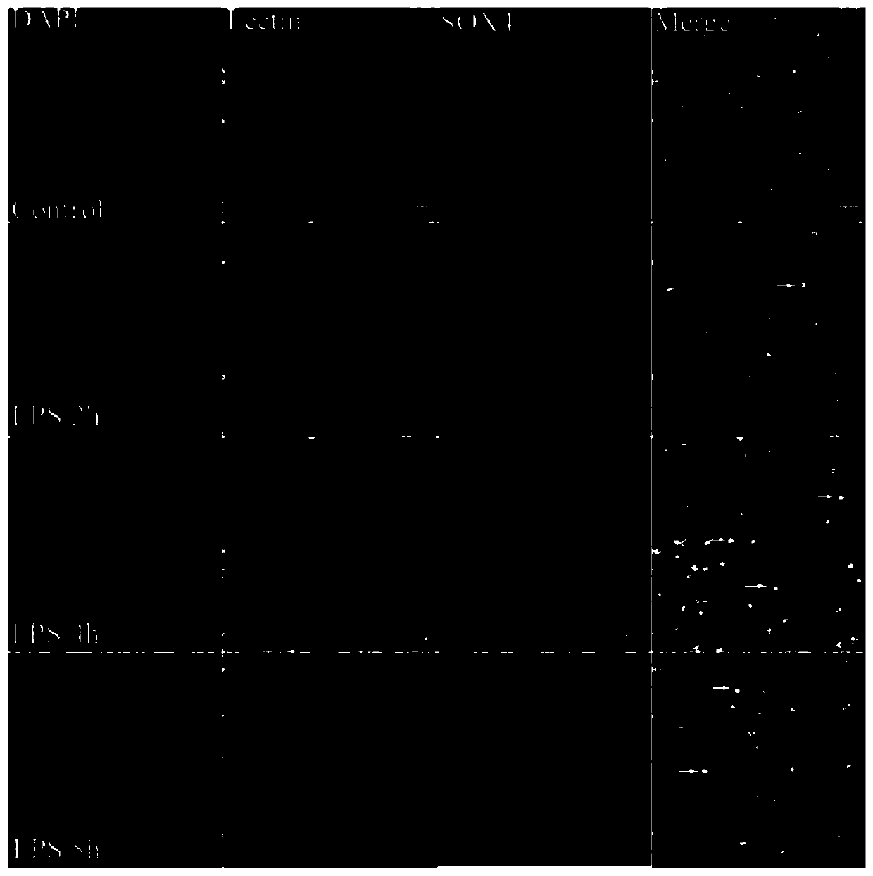 Application of SOX4 inhibitor and medicine containing SOX4 inhibitor