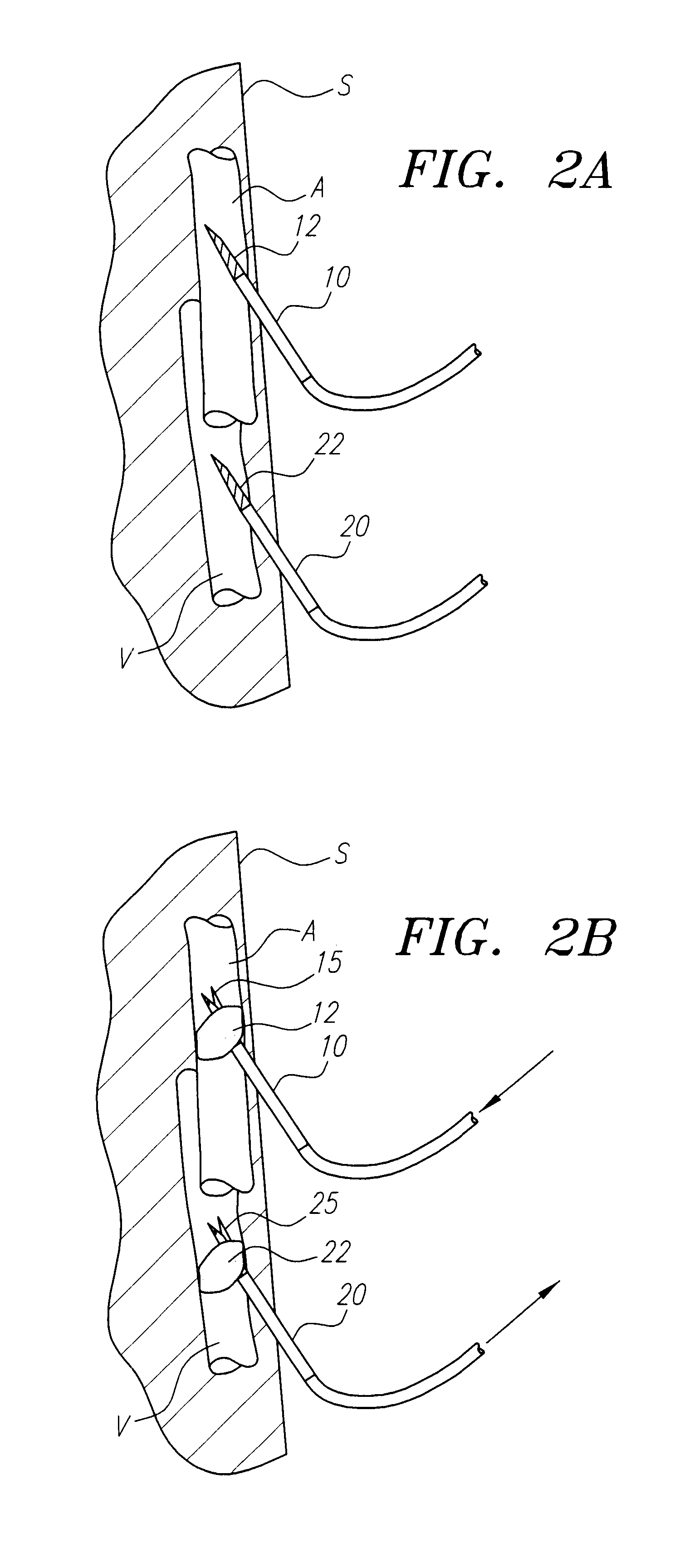 Intravascular methods and apparatus for isolation and selective cooling of the cerebral vasculature during surgical procedures