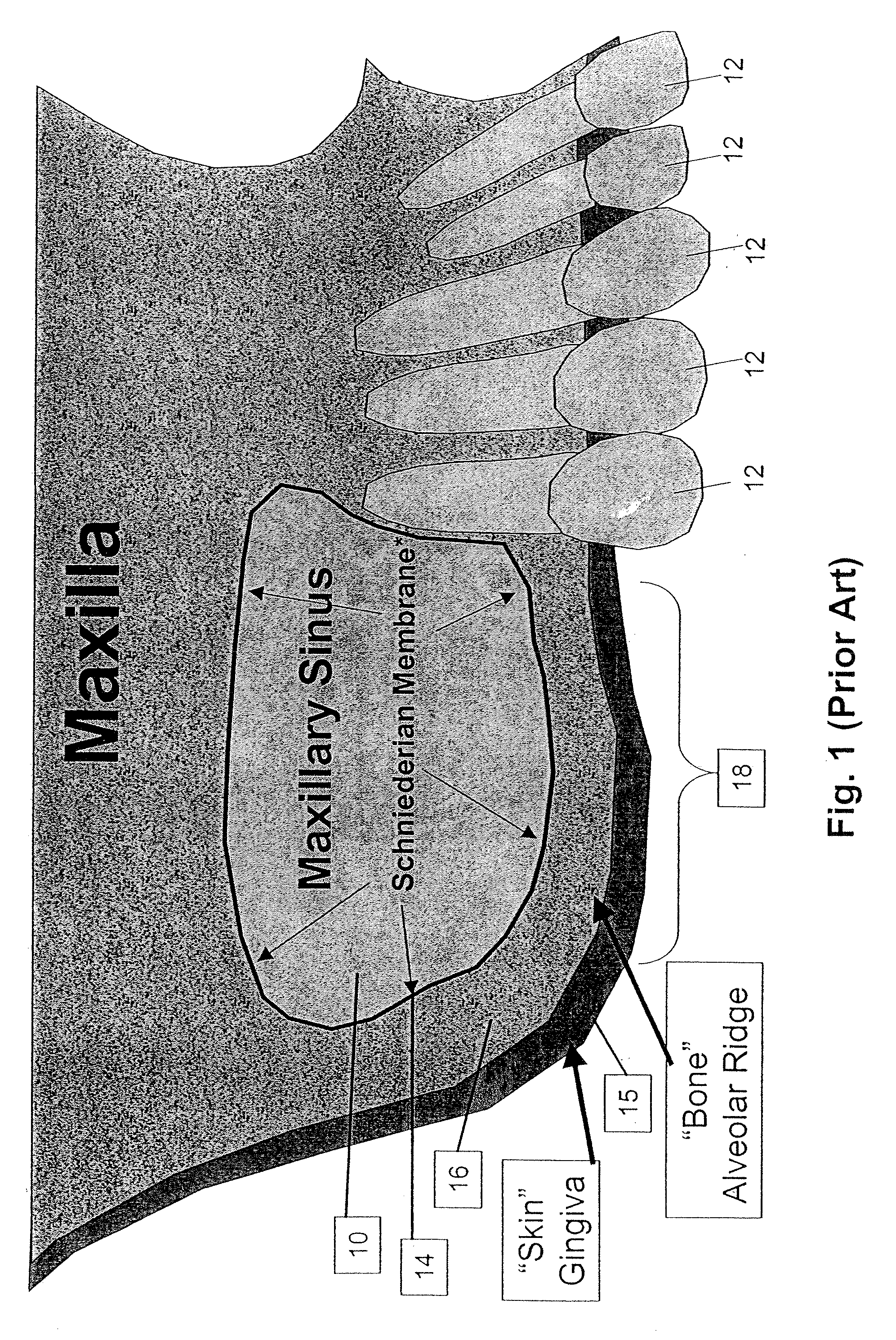 Method and apparatus for performing maxillary sinus elevation