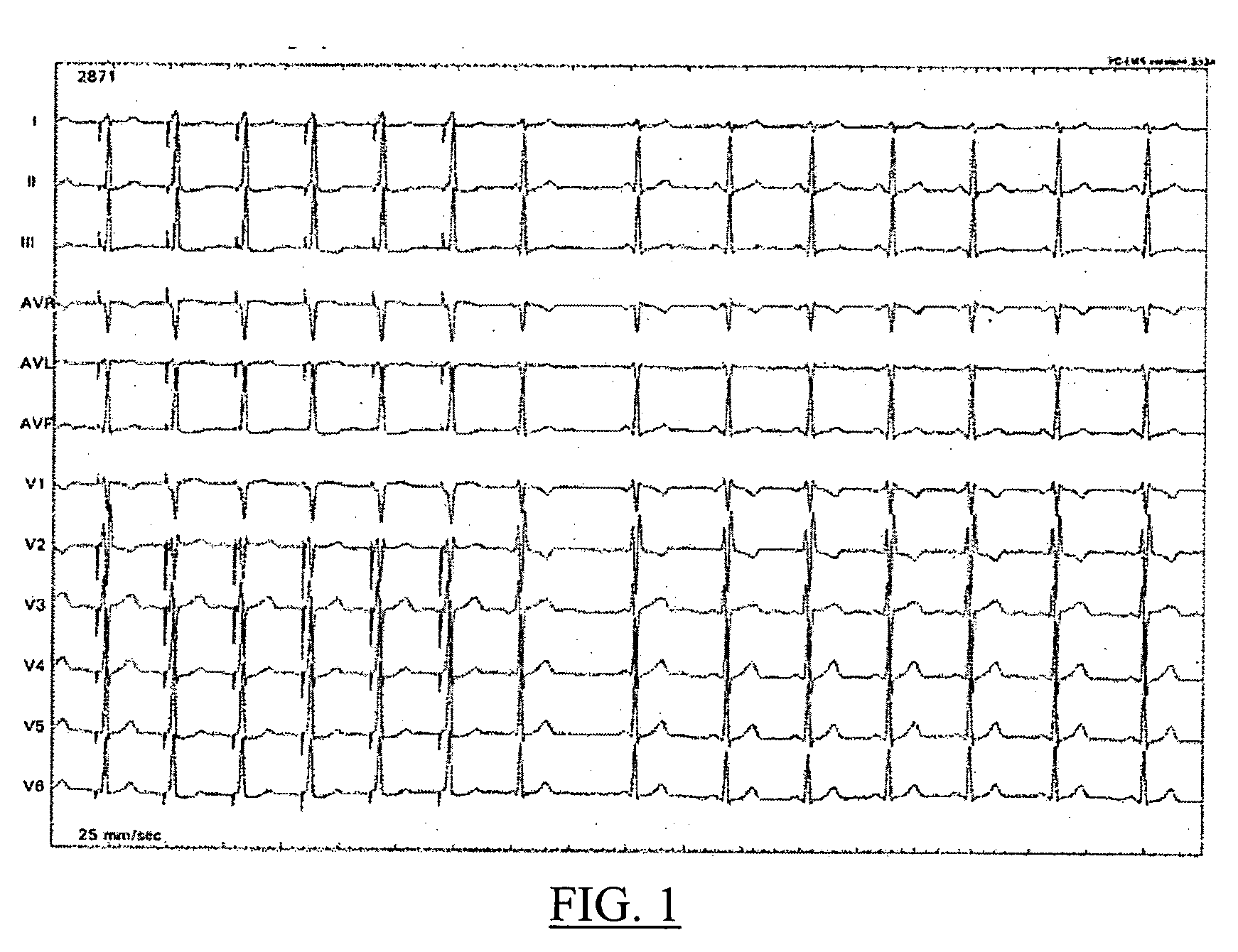 Pacemaker which reestablishes or keeps the physiological electric conduction of the heart and a method of application