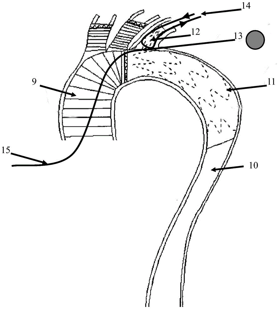 Intraoperative branched on-demand block stent type artificial blood vessel system and use method