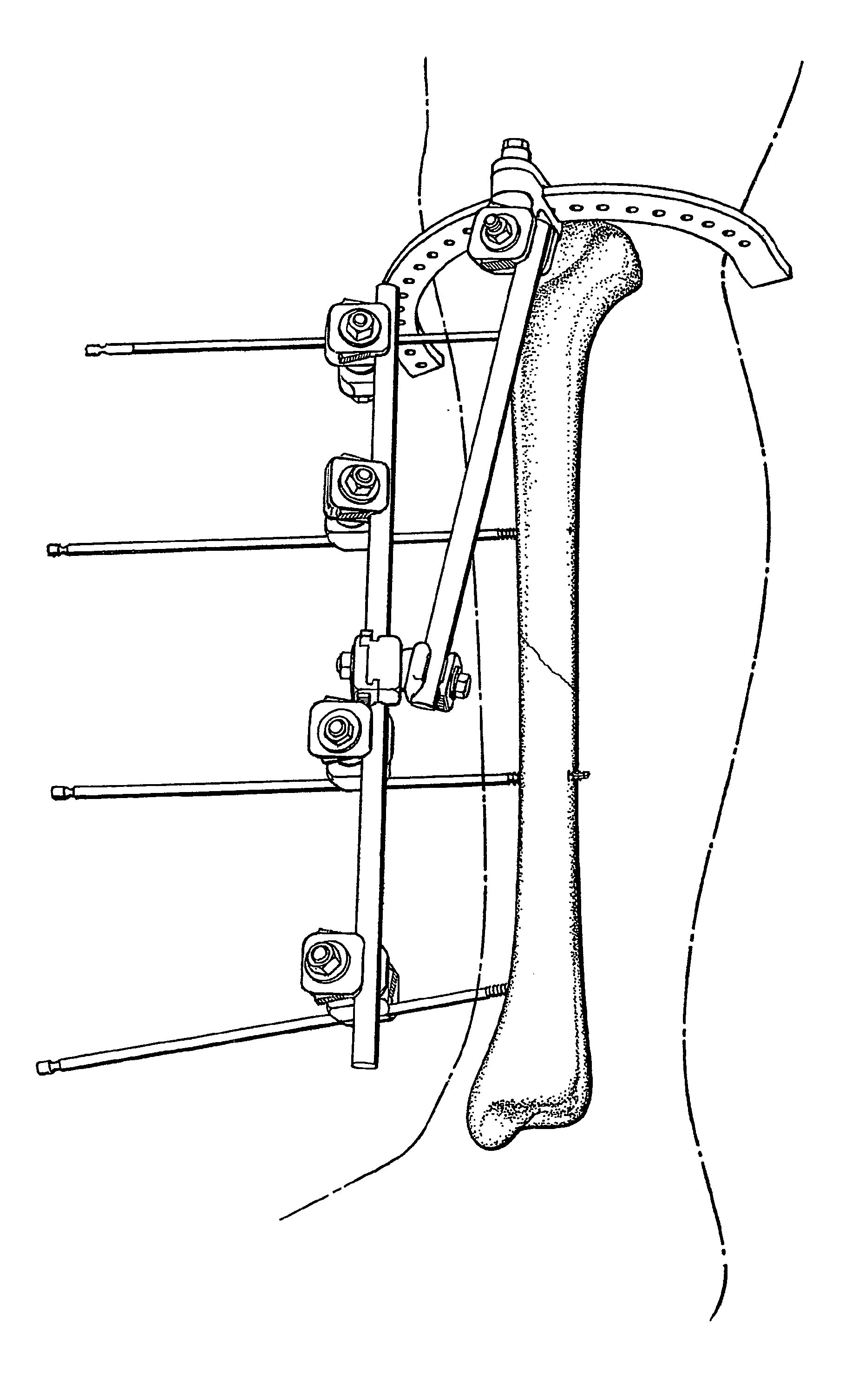 Device and methods for placing external fixation elements