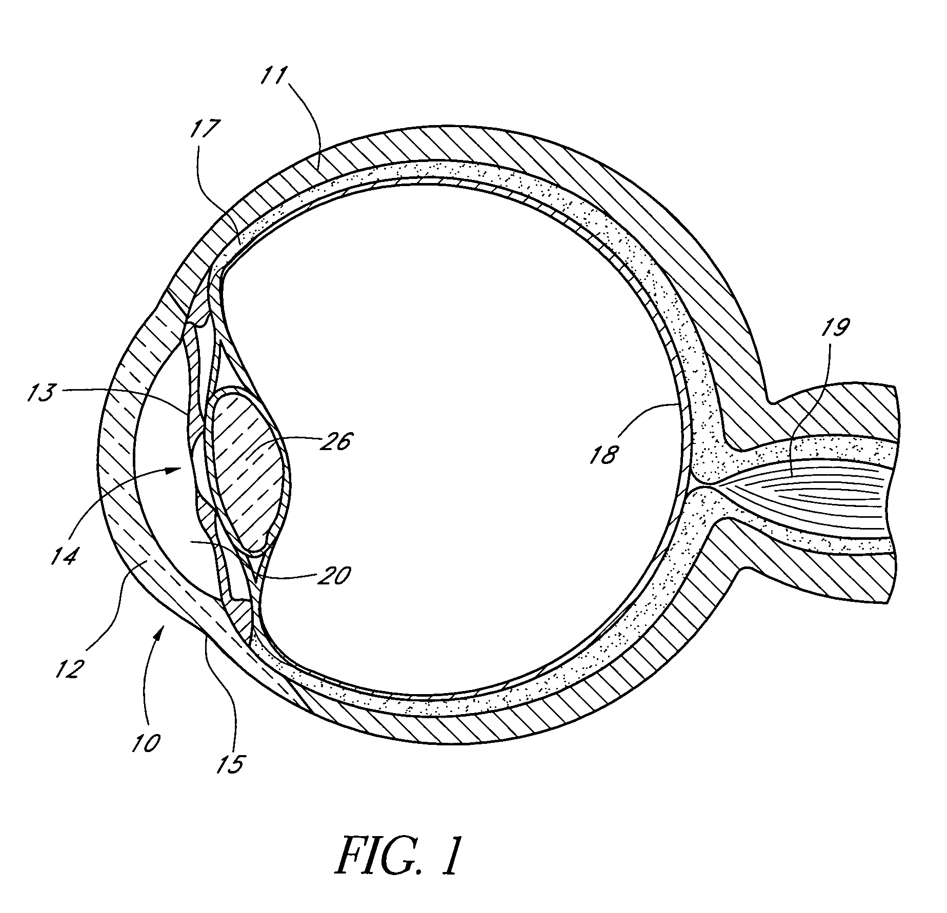 Combined treatment for cataract and glaucoma treatment