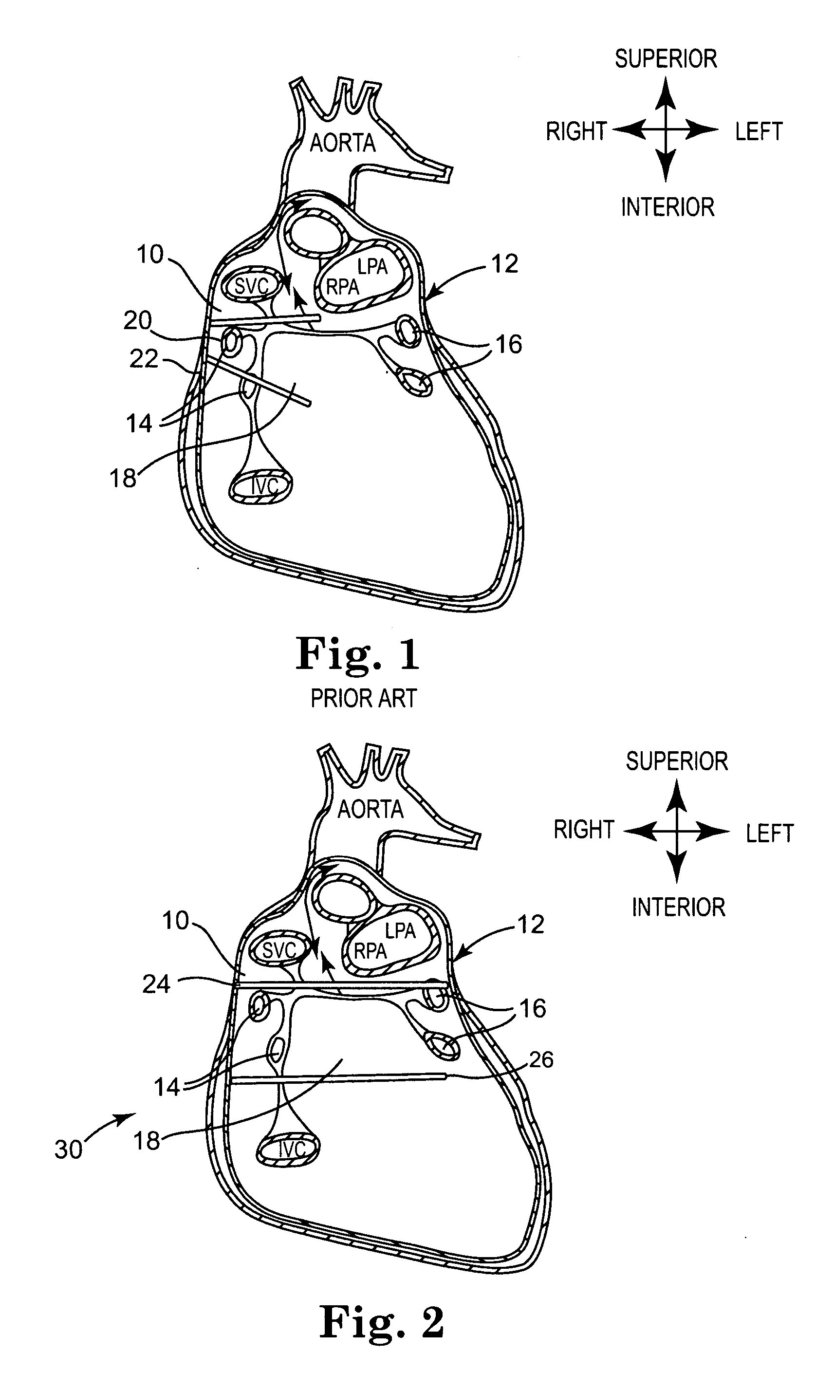 Compound bipolar ablation device and method