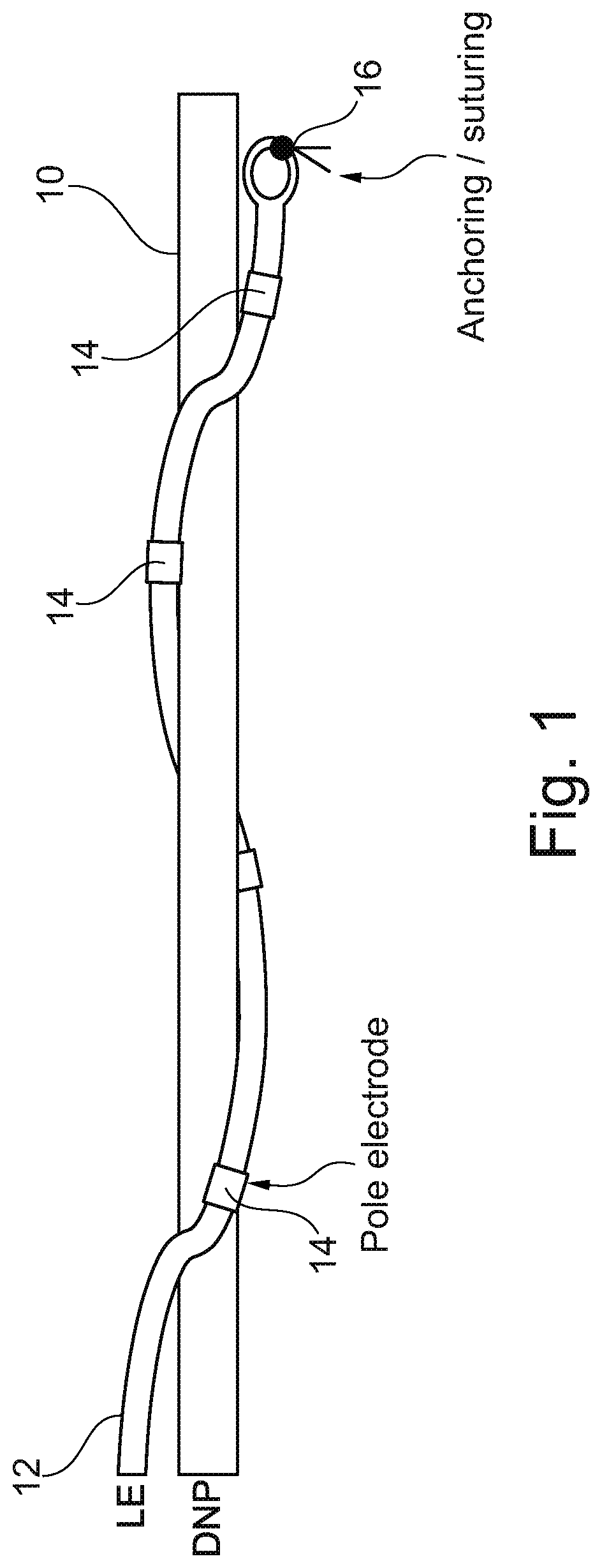 Implantable neurostimulator and methods for implanting and using same