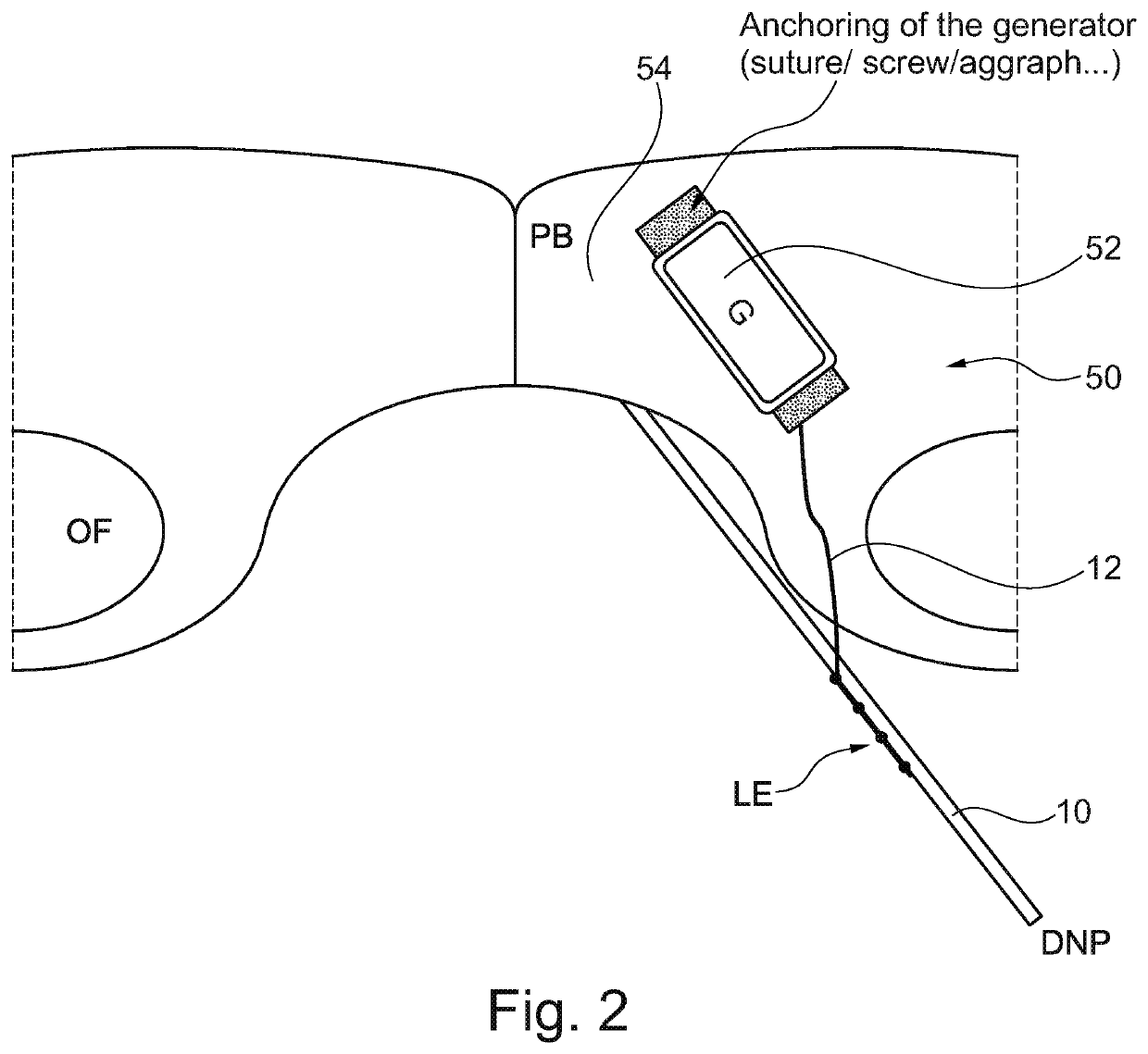 Implantable neurostimulator and methods for implanting and using same