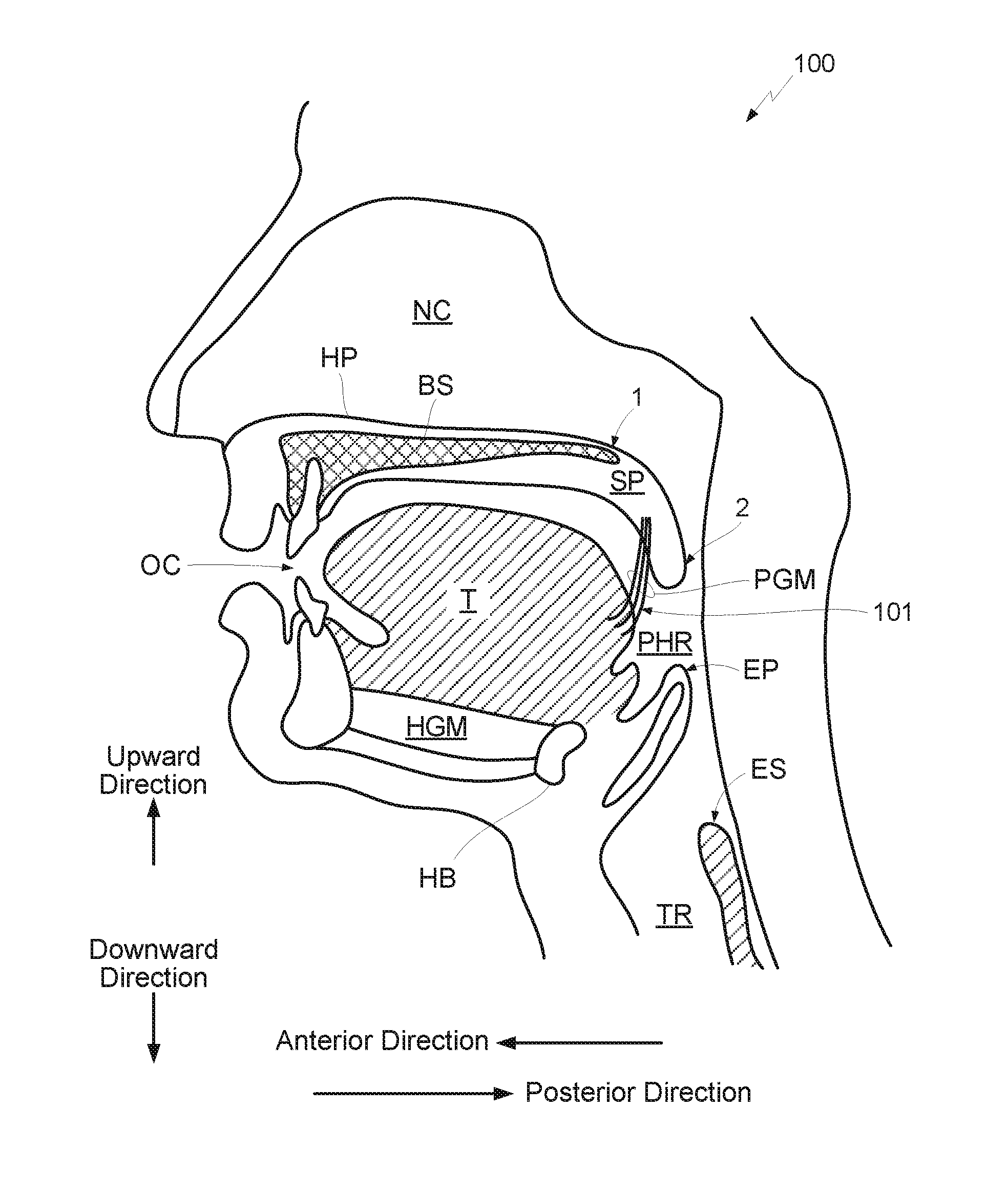 Method and apparatus for treating sleep apnea