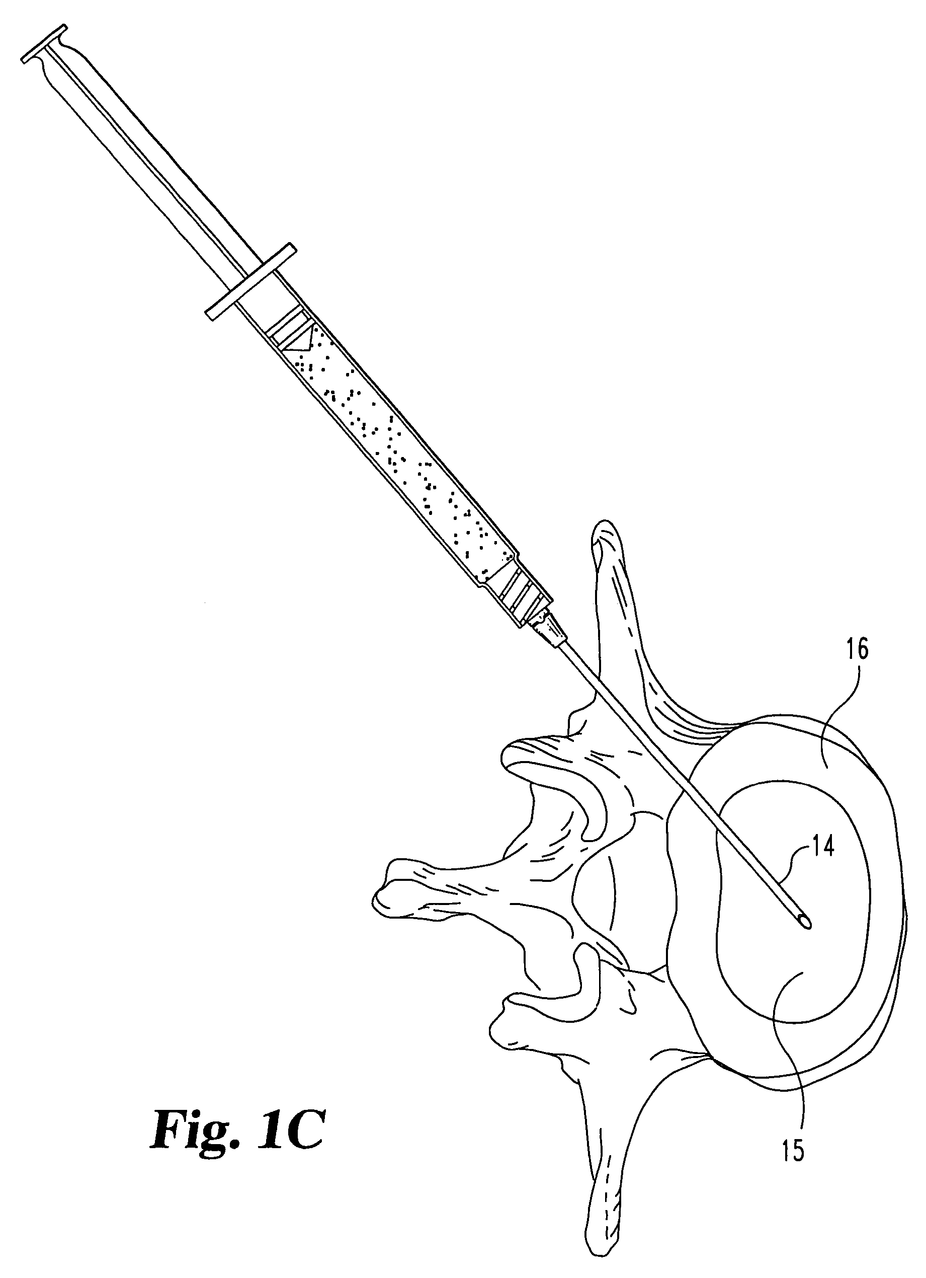 Collagen-based materials and methods for augmenting intervertebral discs