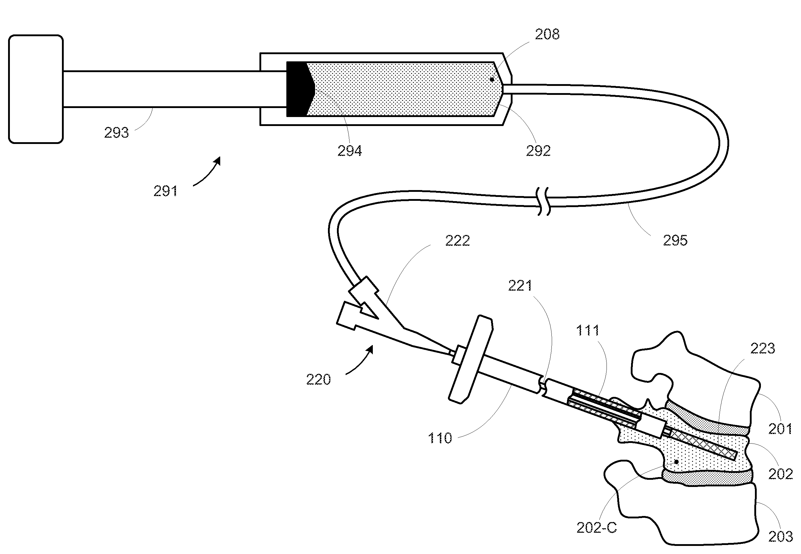 Minimally Invasive Cement Delivery System Retainer