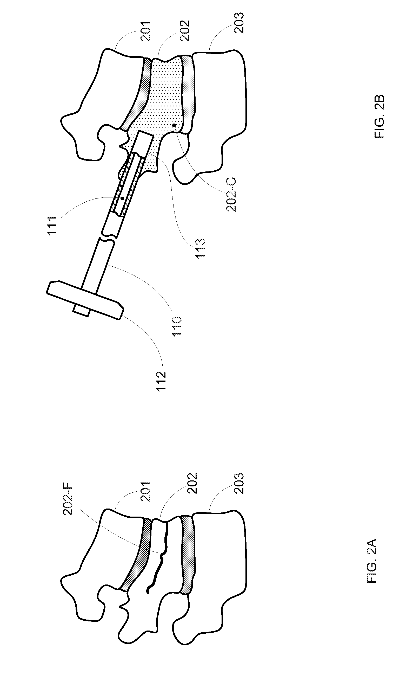 Minimally Invasive Cement Delivery System Retainer