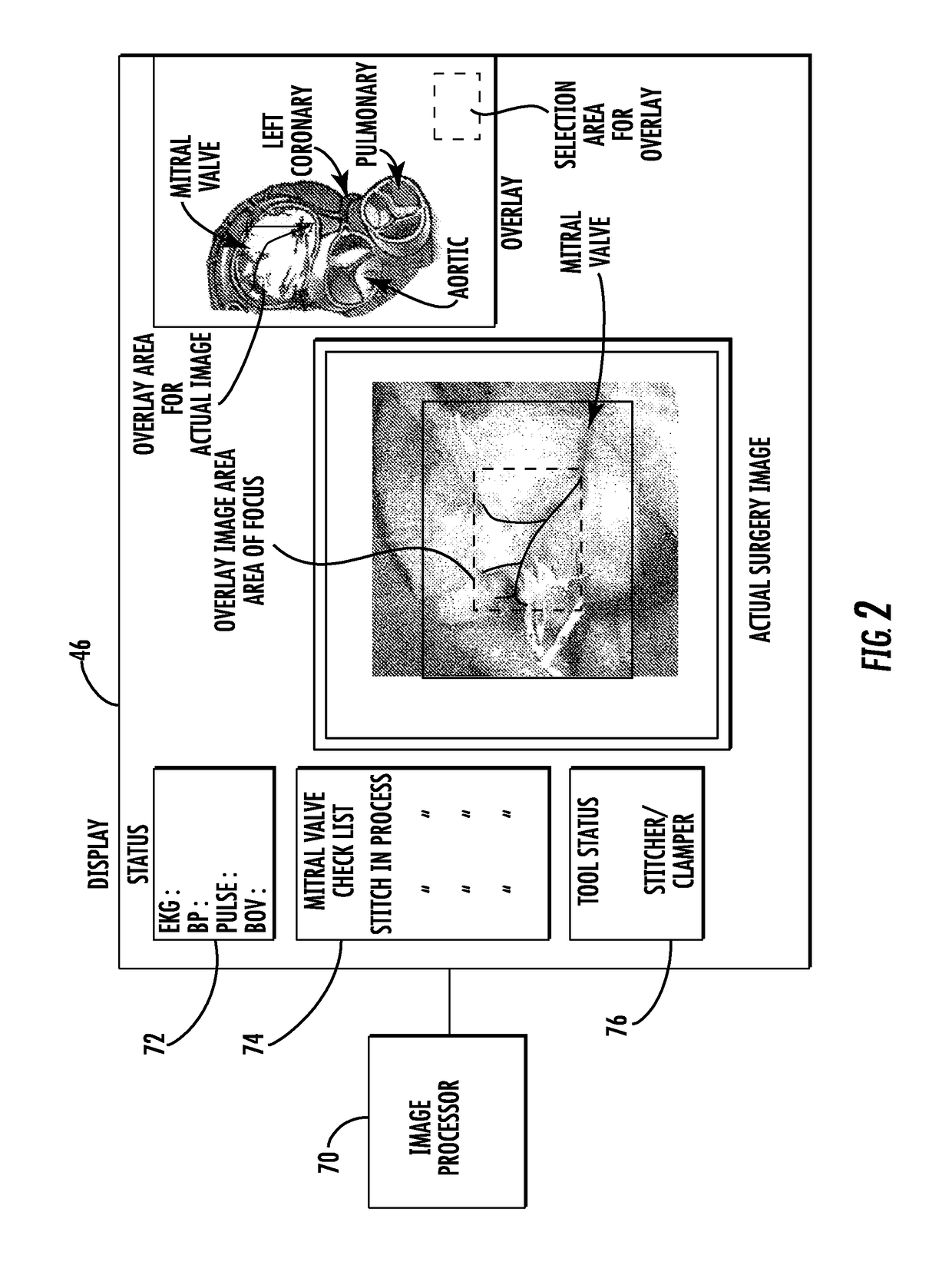 Telerobotic surgery system using minimally invasive surgical tool with variable force scaling and feedback and relayed communications between remote surgeon and surgery station