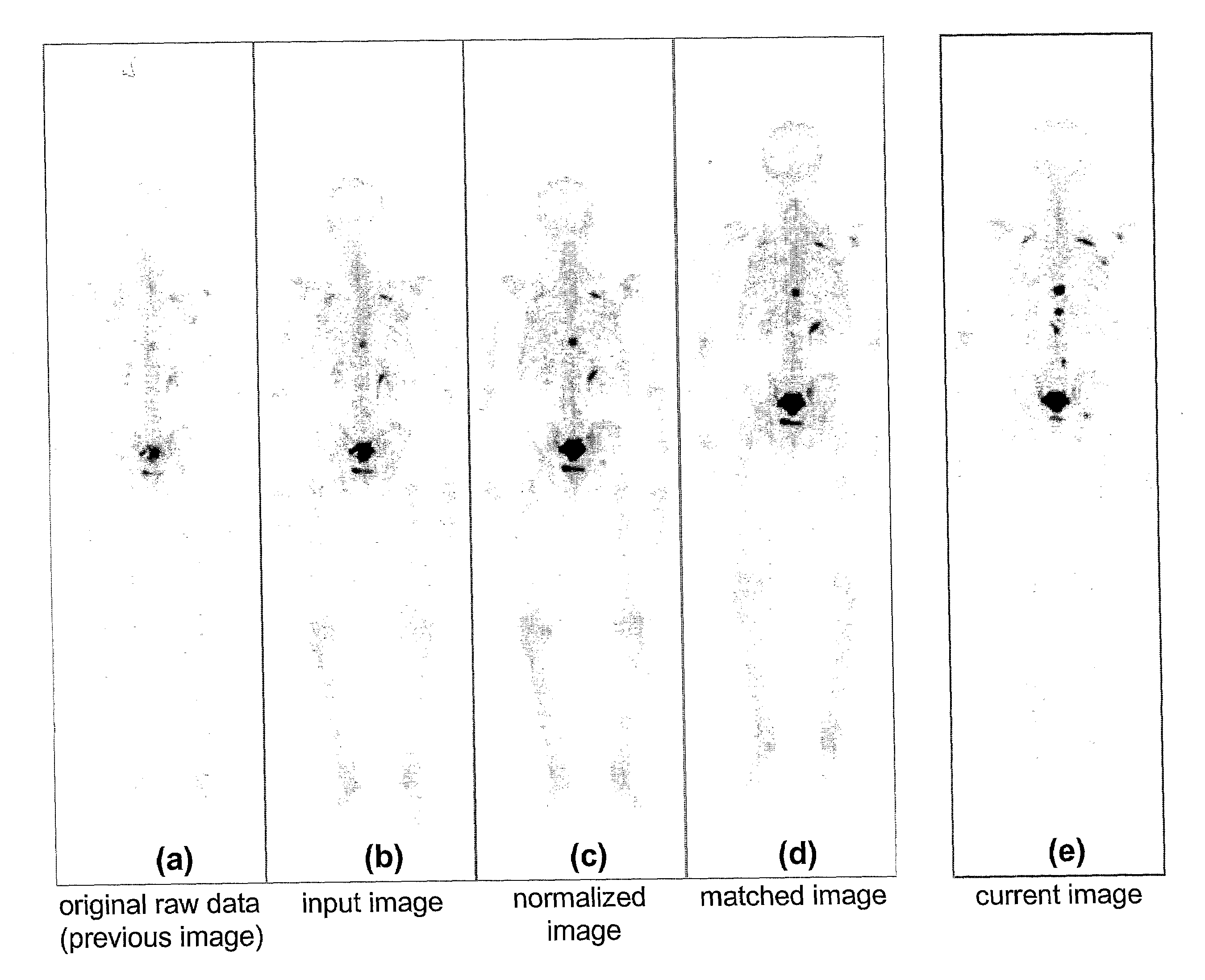 Computer-Aided Method for Detection of Interval Changes in Successive Whole-Body Bone Scans and Related Computer Program Program Product and System