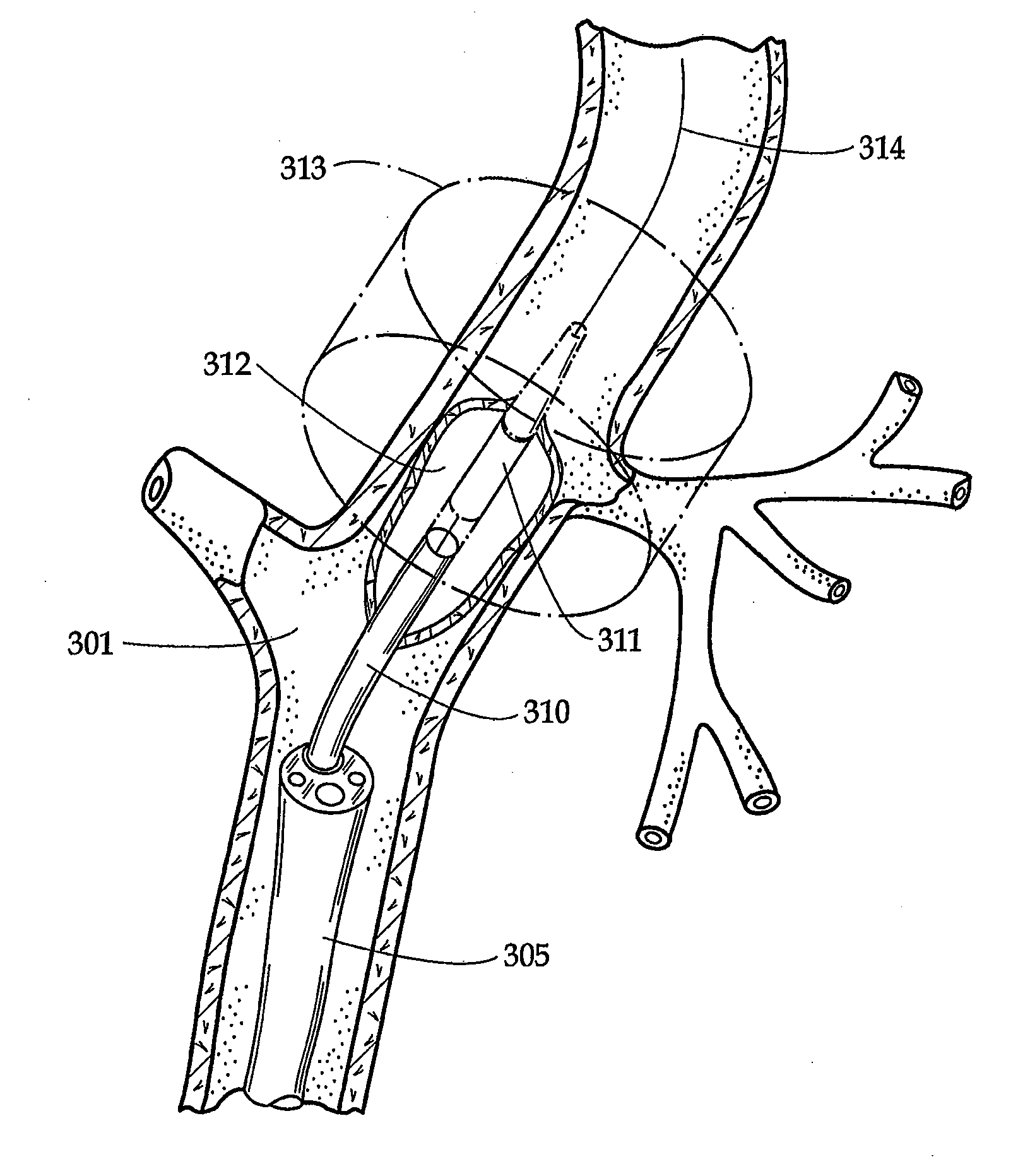 Ultrasound imaging sheath and associated method for guided percutaneous trans-catheter therapy