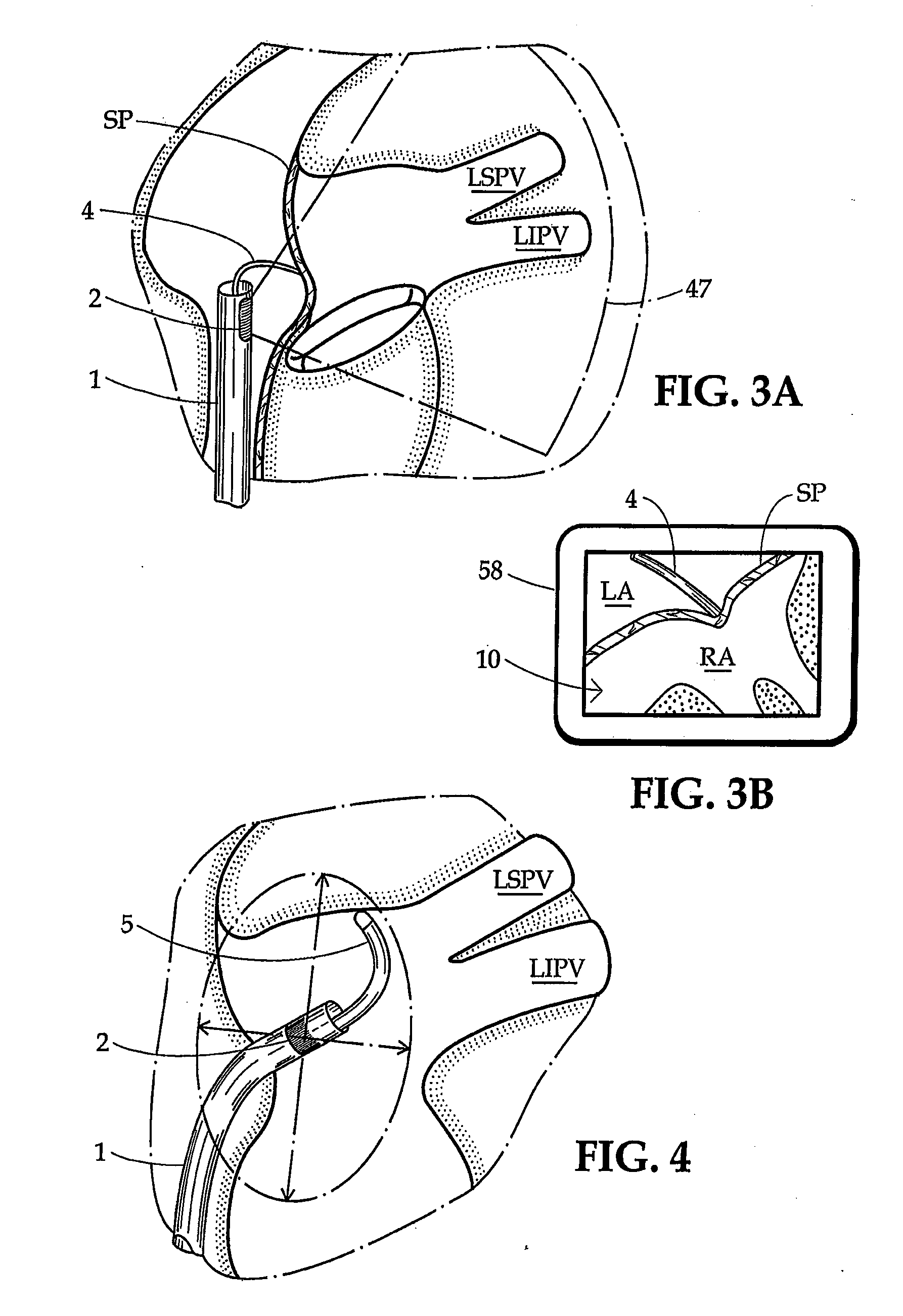 Ultrasound imaging sheath and associated method for guided percutaneous trans-catheter therapy