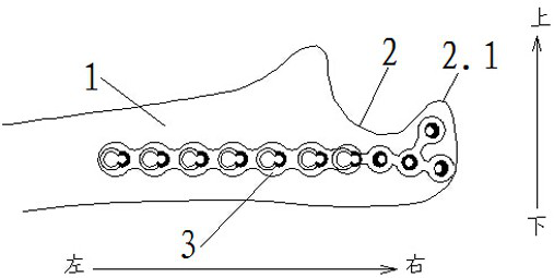 Ulna olecranon morphological anatomy locking method and steel plate structure
