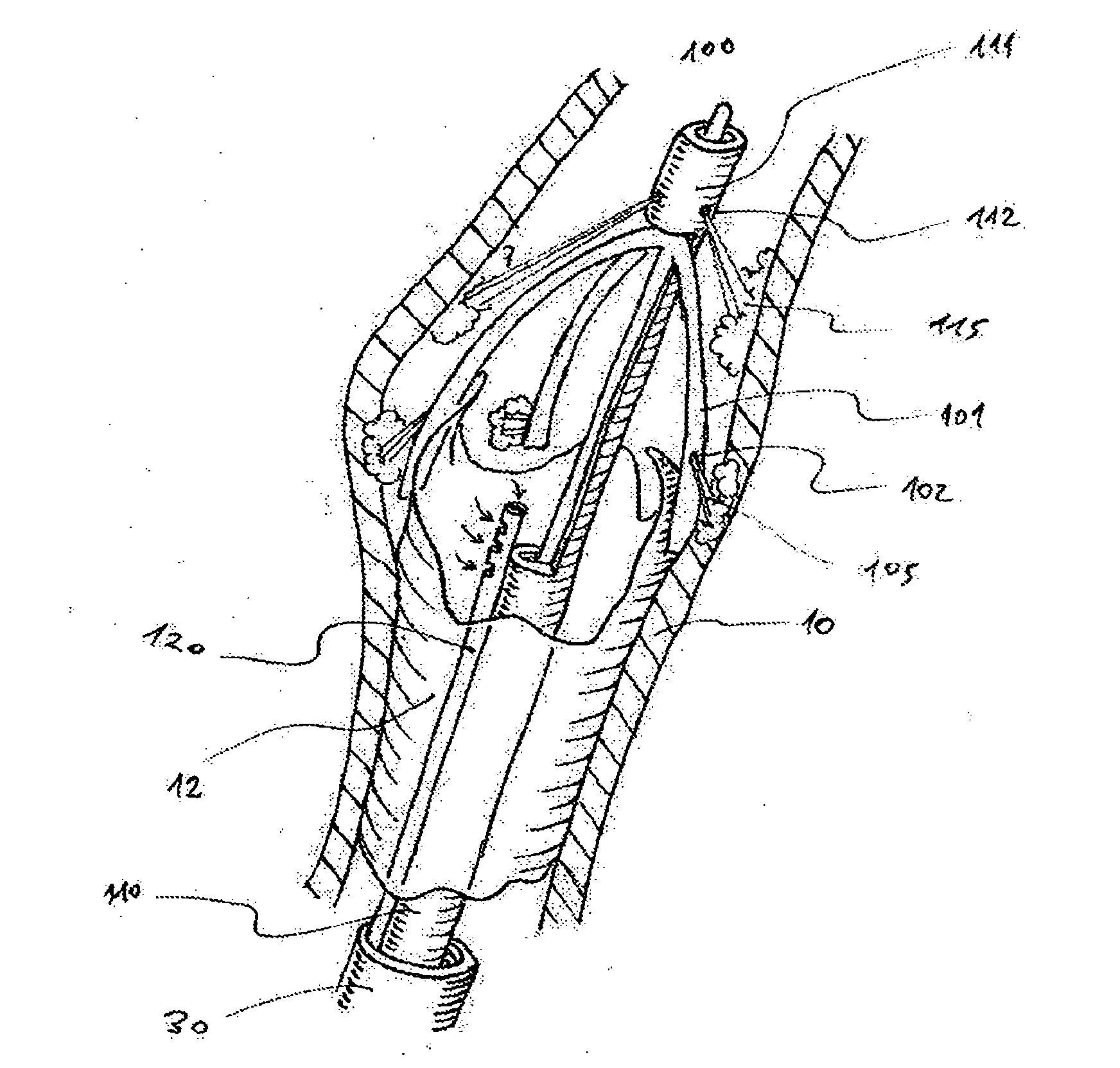 Devices and methods for percutaneous endarterectomy