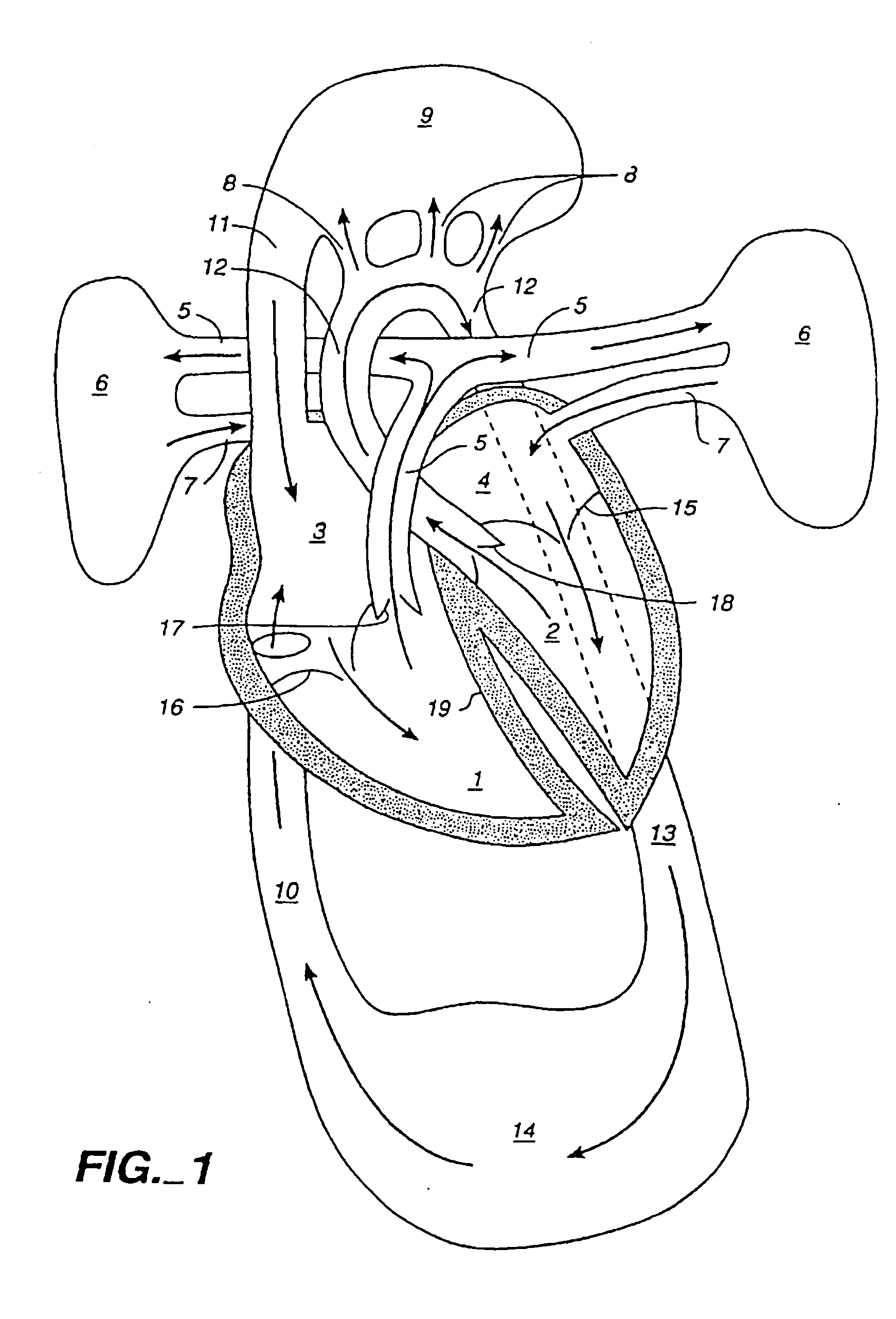 Venous cannula and cardiopulmonary bypass system
