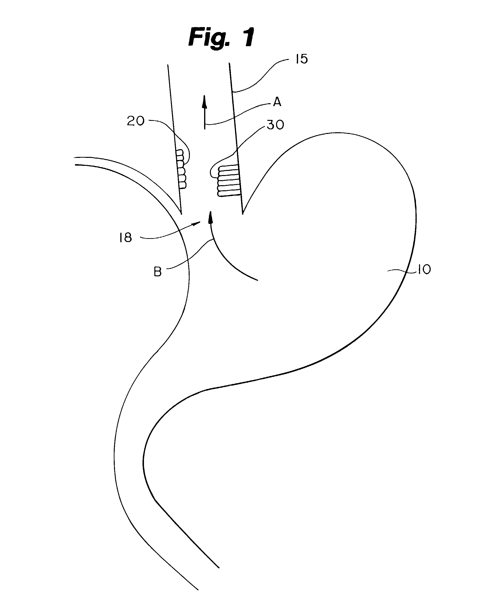 Method of treating abnormal tissue in the human esophagus