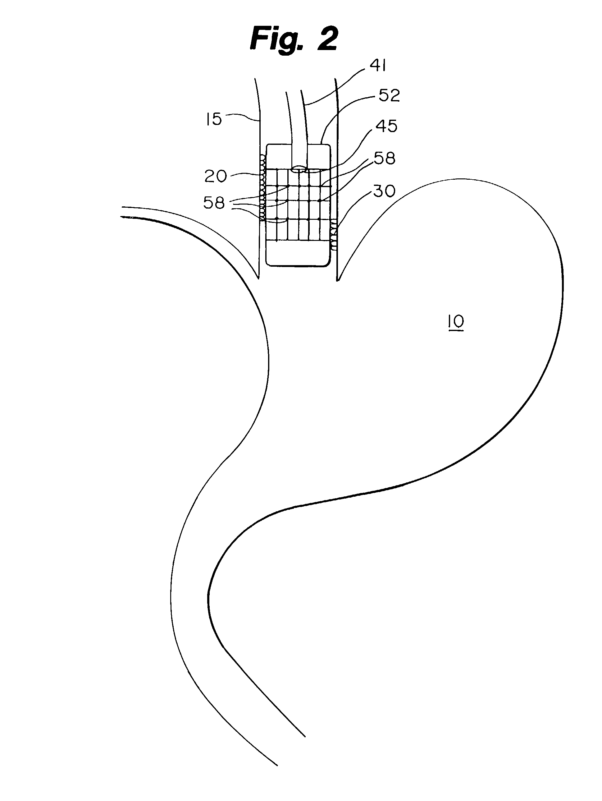 Method of treating abnormal tissue in the human esophagus
