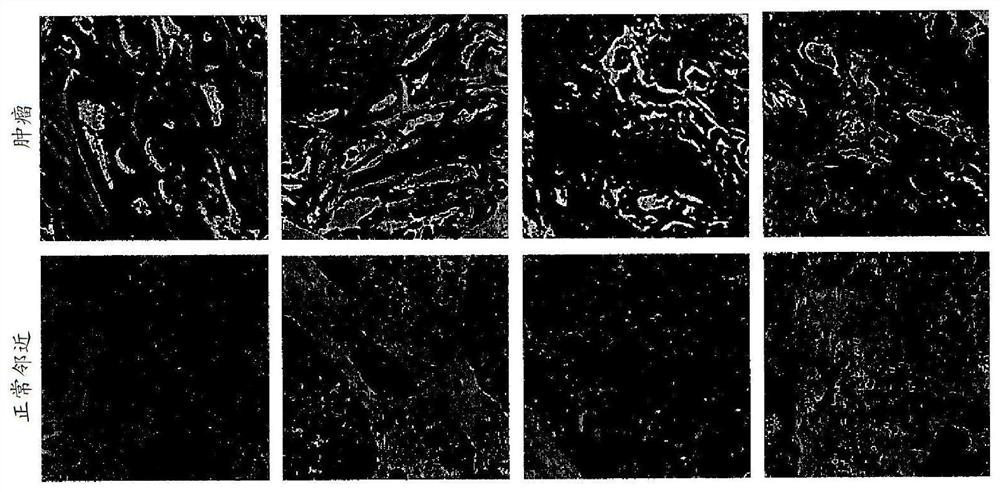 Monoclonal antibody neo-201 for the treatment of human carcinomas