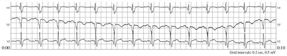 A Classification Method of Vector Cardiogram Based on Nonlinear Dynamic Features