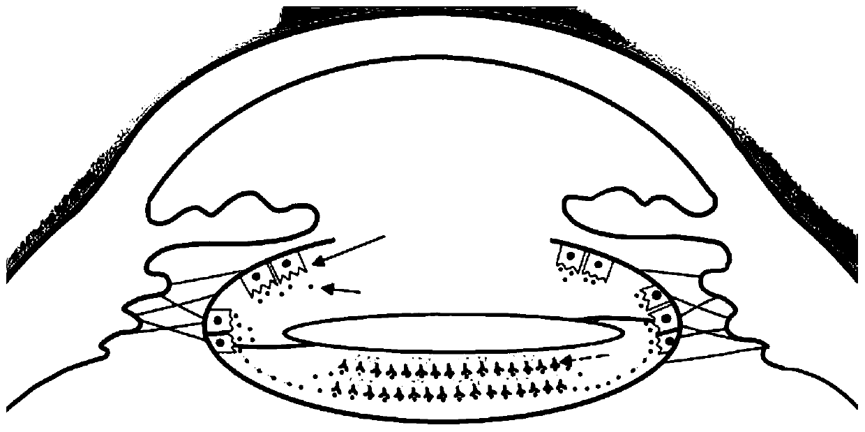 Intraocular lens with divisionally modified rear surface and preparation method of intraocular lens