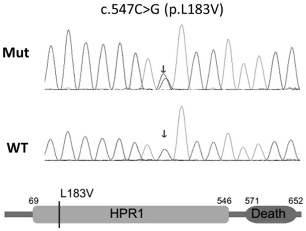 hpr1 gene mutant and its application in the preparation of deafness diagnostic reagents