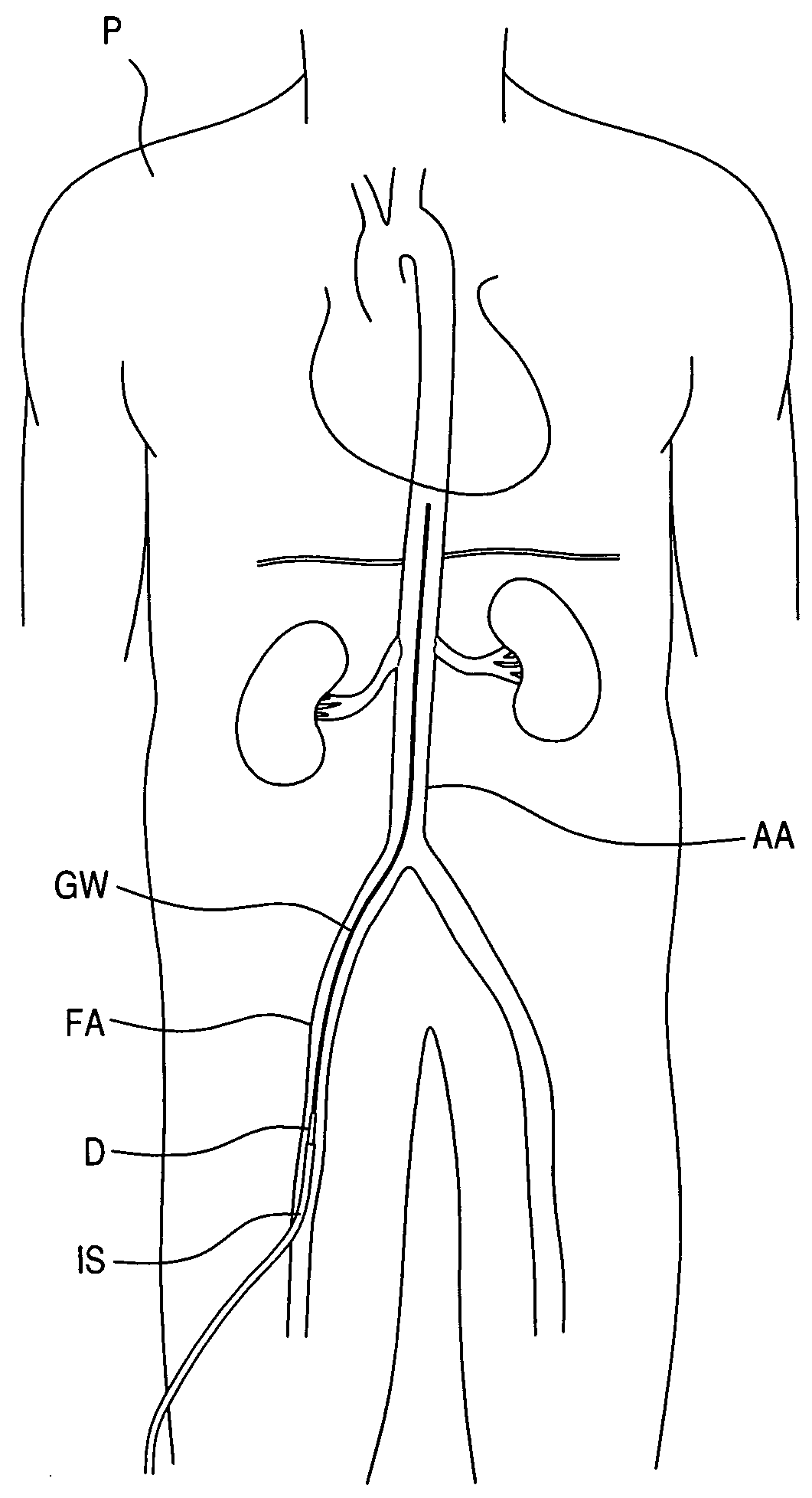 Vascular dilator for controlling blood flow in a blood vessel