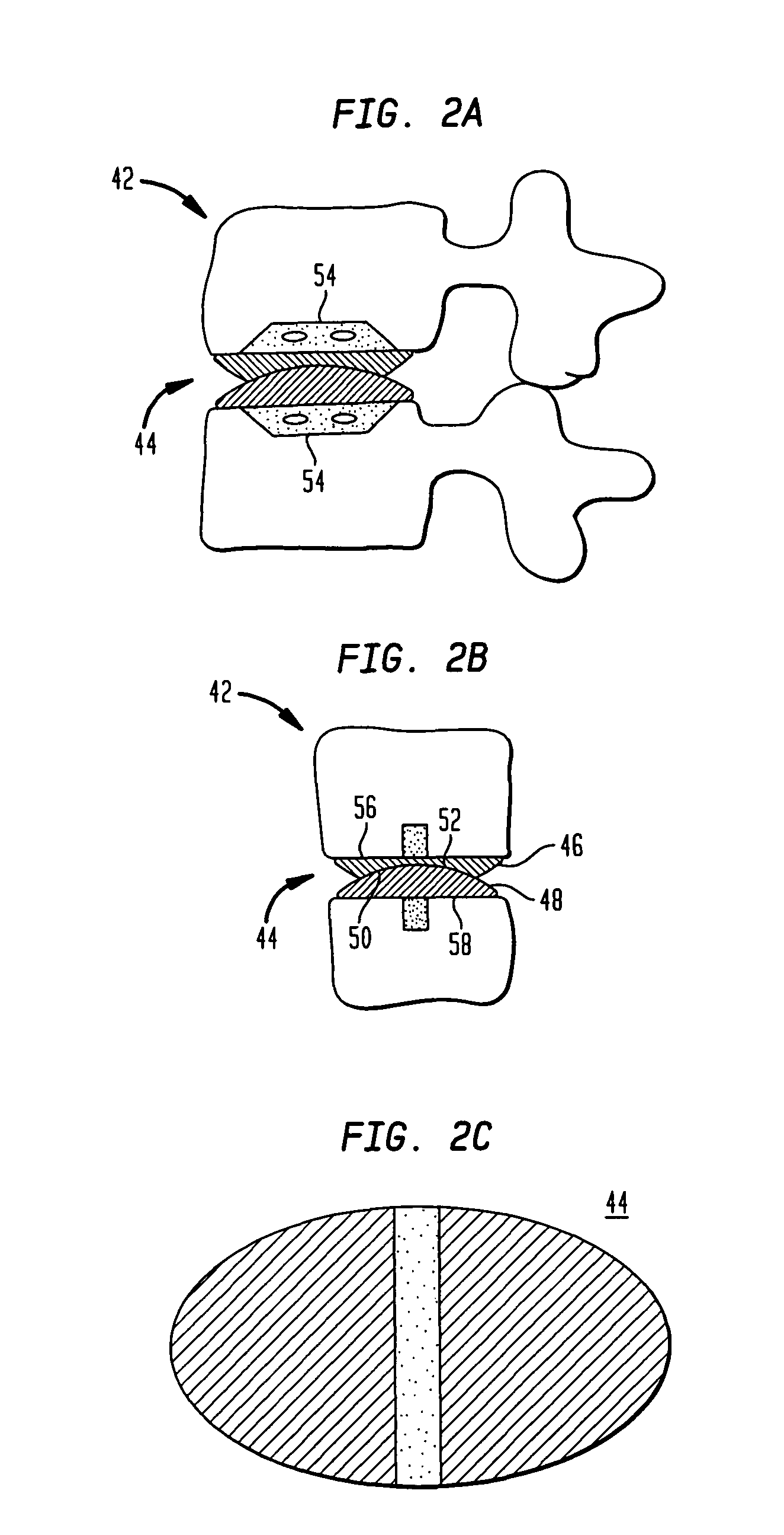 Two-component artificial disc replacements